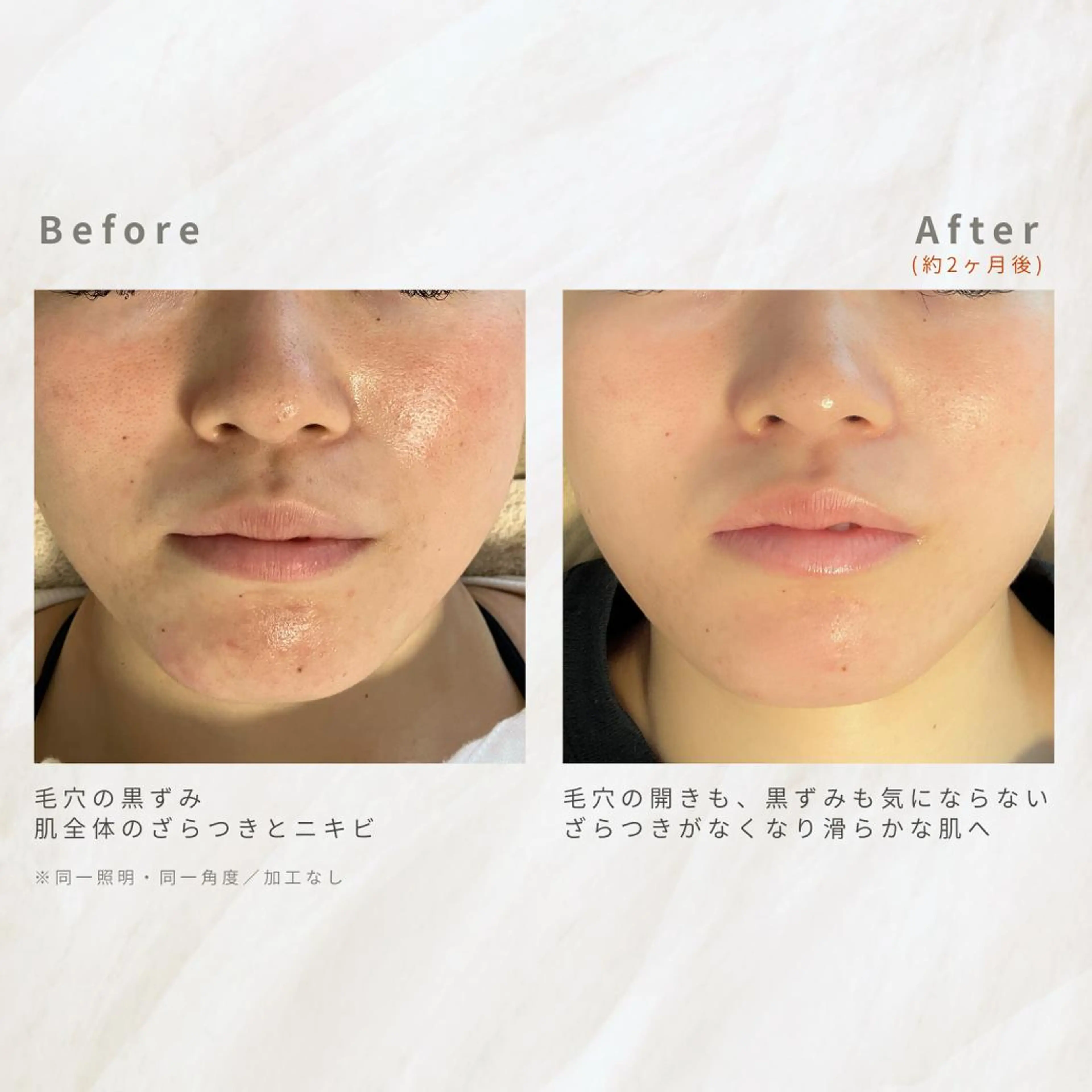 繰り返すニキビ・毛穴 ✨つくば肌質改善専門のエステ・リラクイメージ