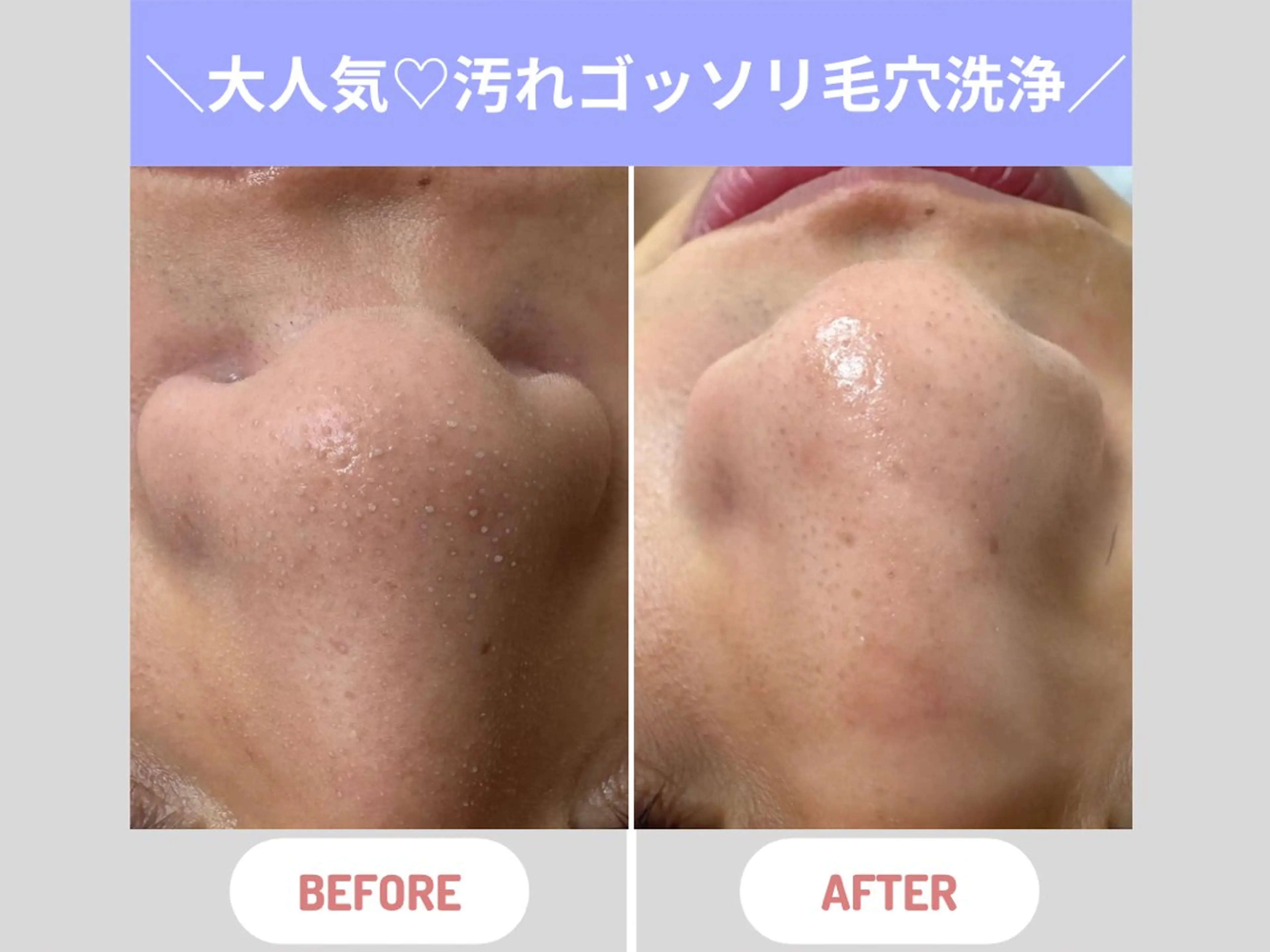 エステ Mr.&Ms.脱毛/ ピーリング/RINAのエステ・リラクイメージ