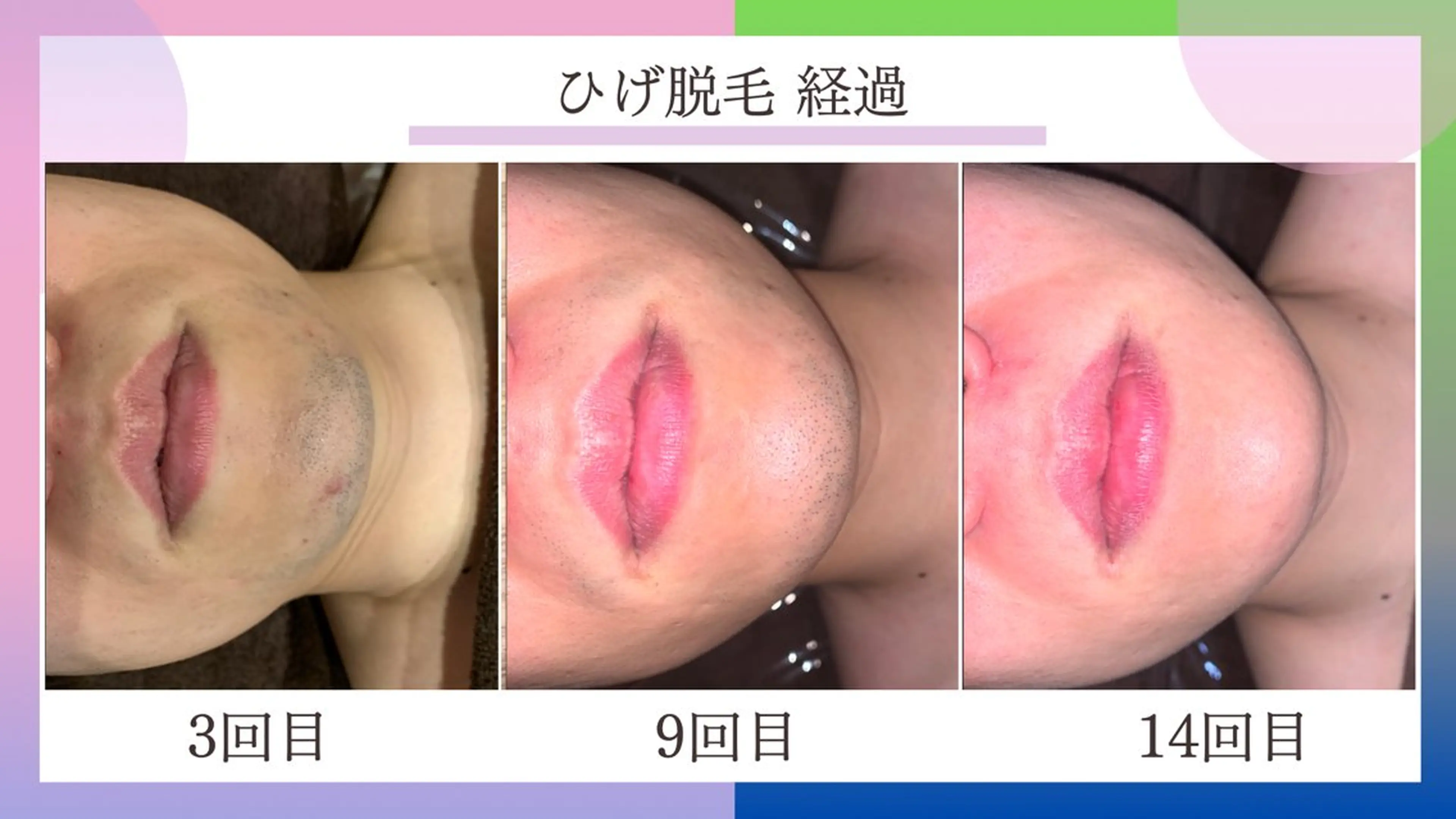 メンズ 脱毛 【天神|個室】脱毛 You Makeのエステ・リラクイメージ