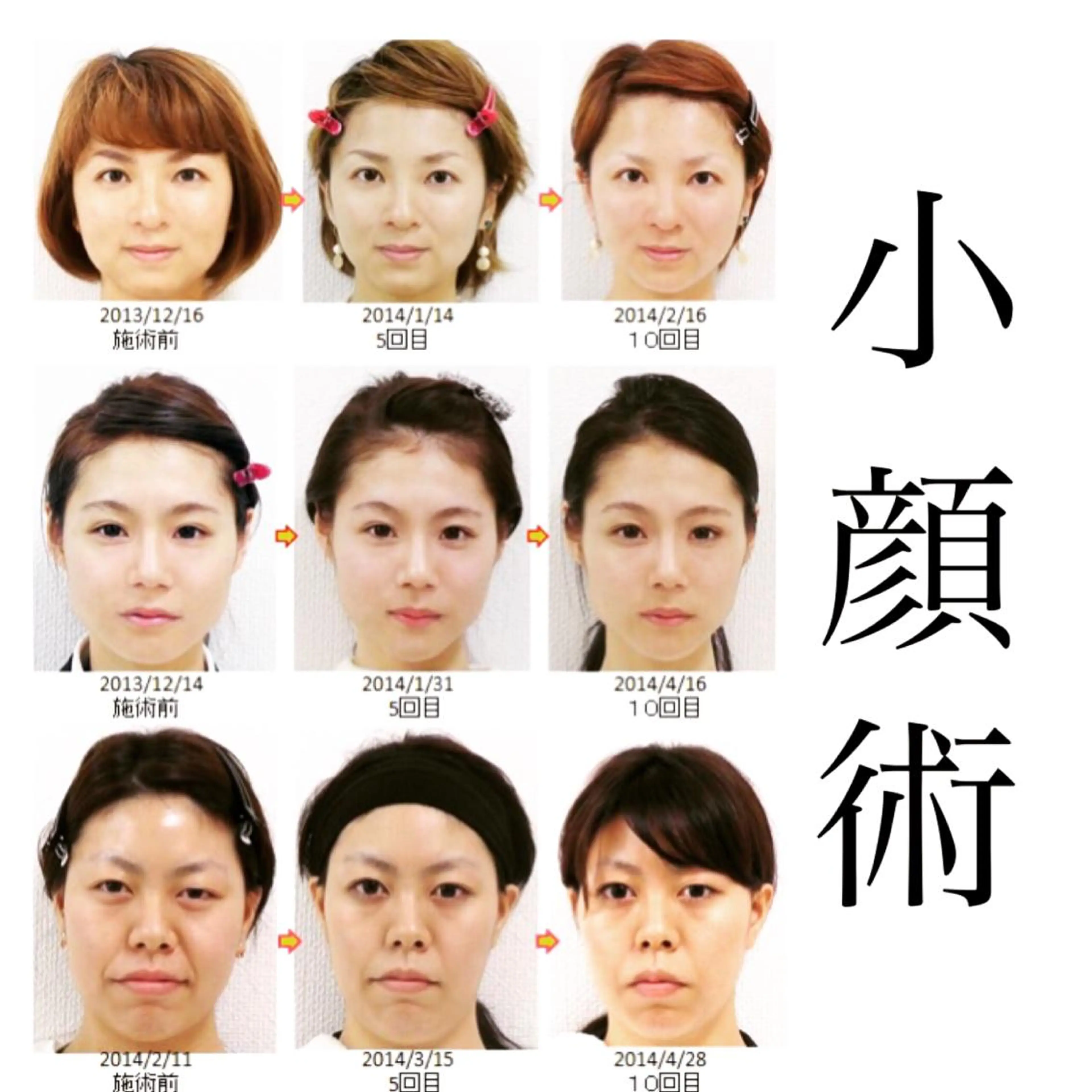 人数限定★ミニモ限定👑初回体験＋2回施術の3回券！残り4名の写真