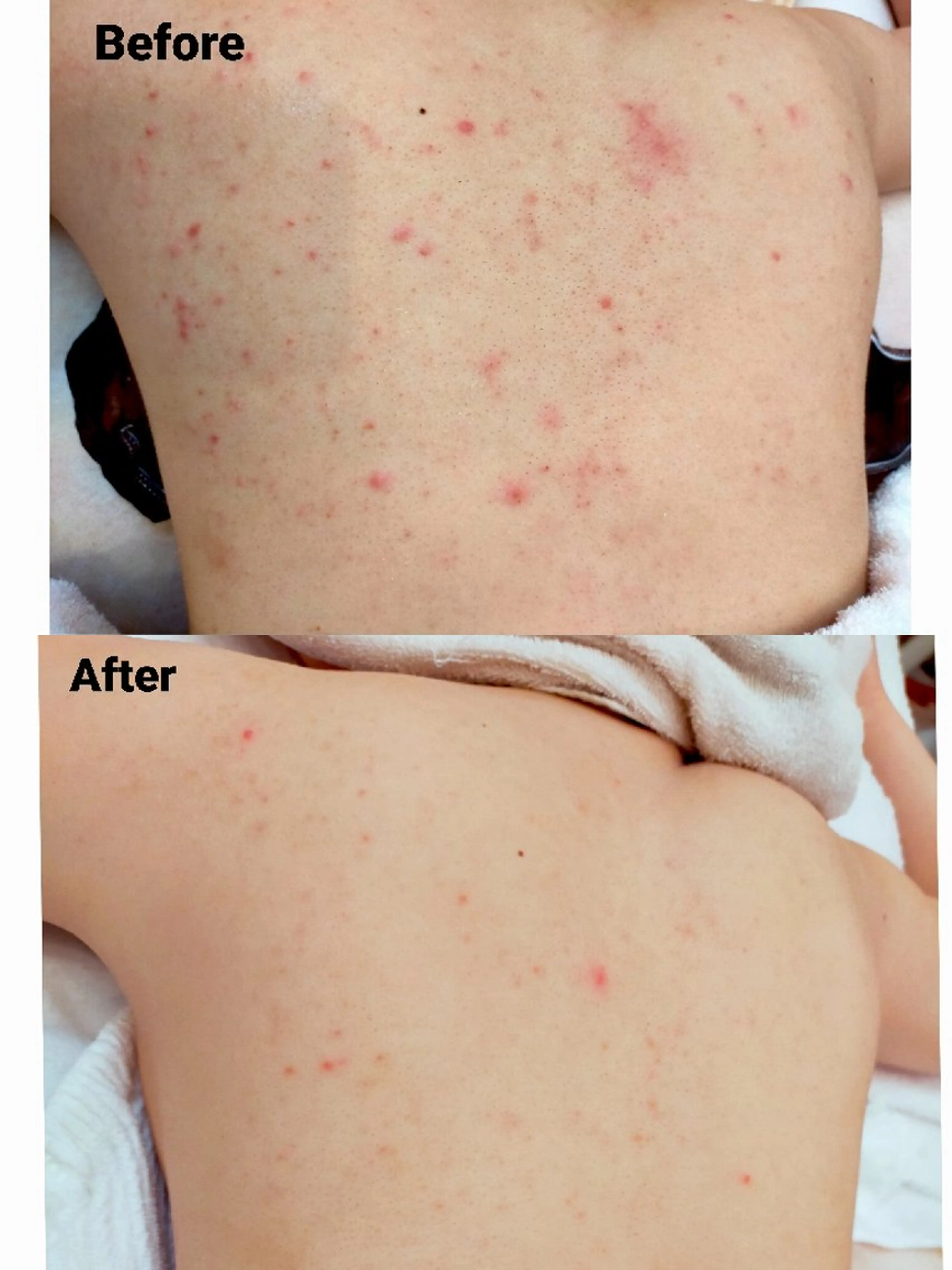 【背中の赤いポツポツ】後ろ姿に自信！ 背中ニキビケアの写真