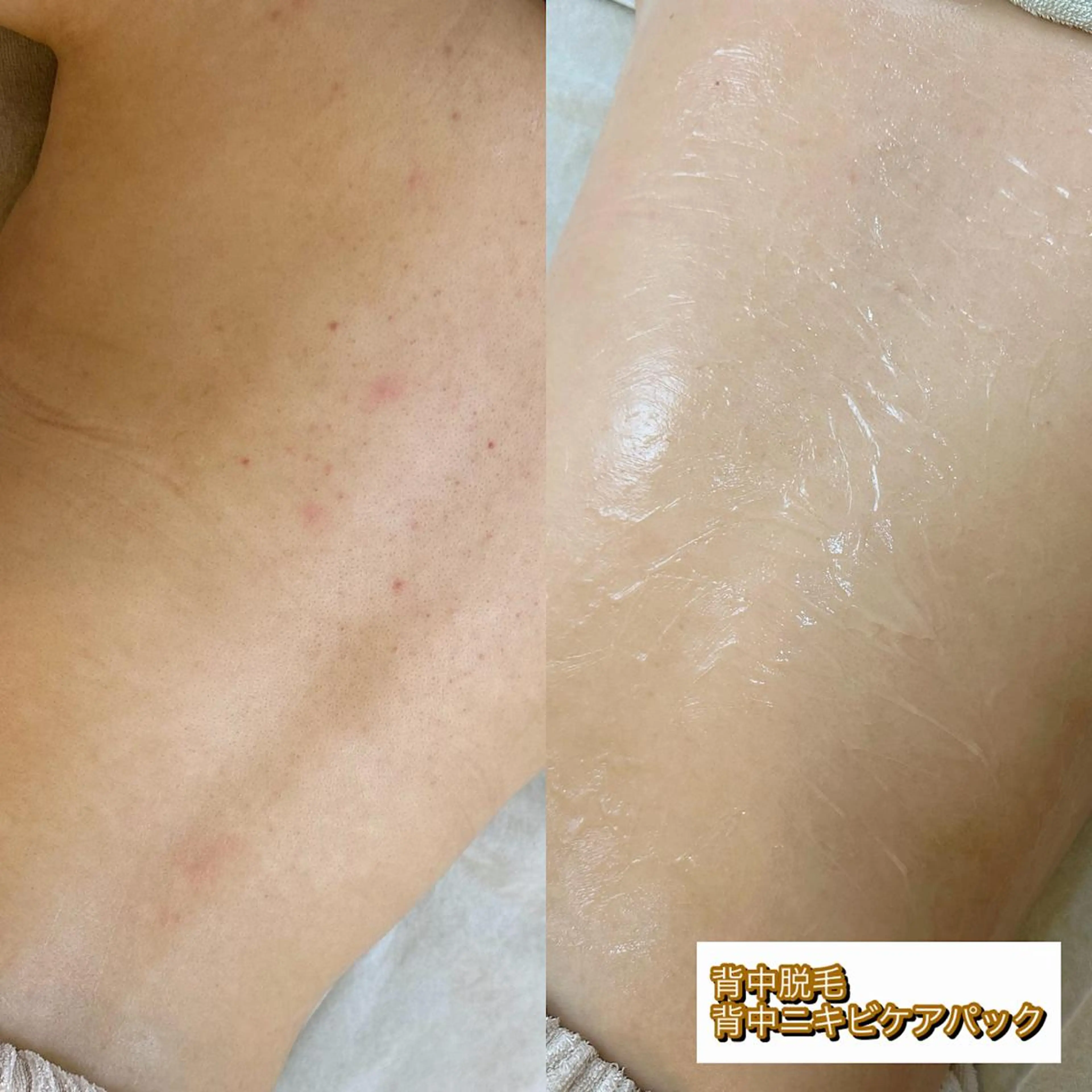 うなじ脱毛/美肌脱毛 LABELのエステ・リラクイメージ