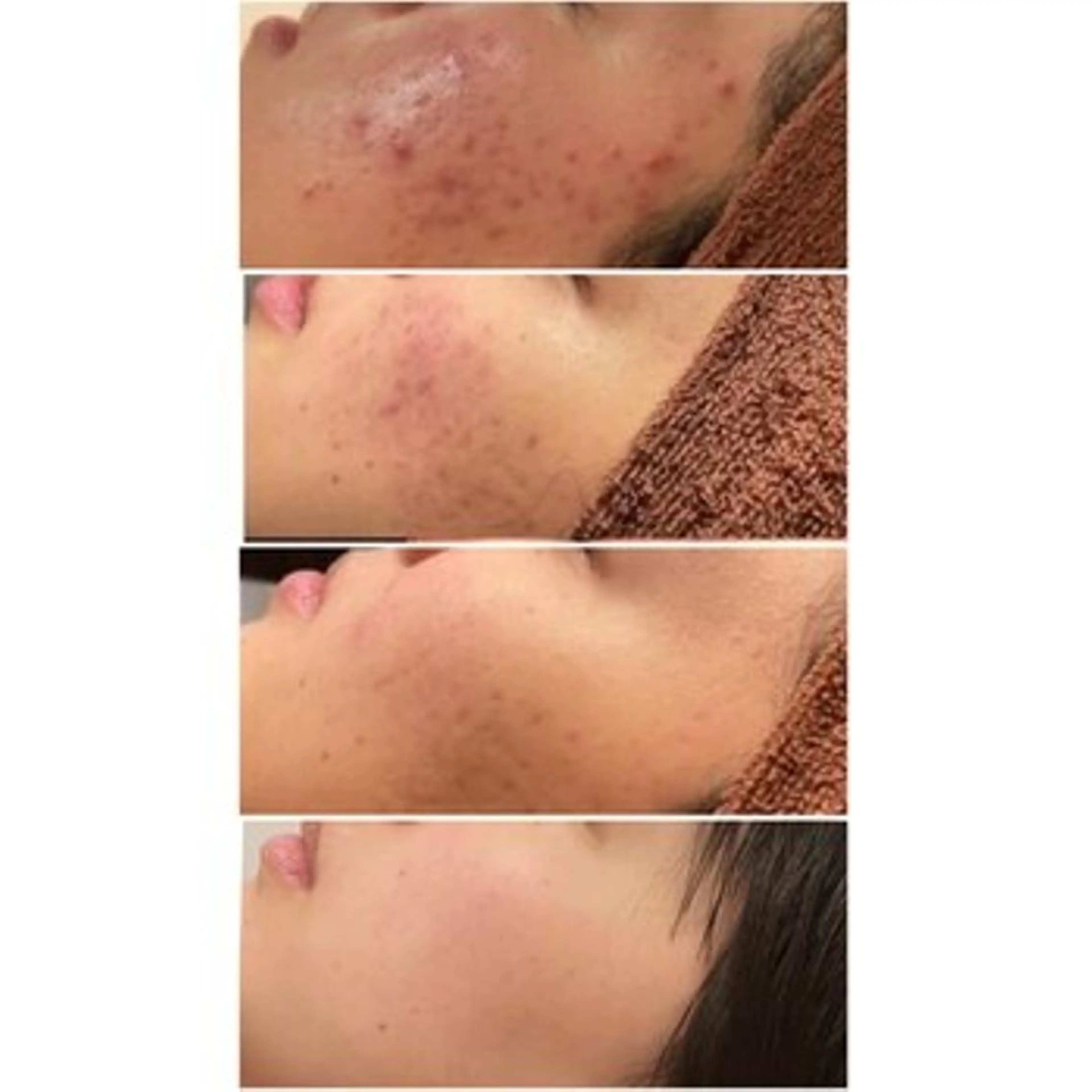 エステ リラク ニキビ跡改善専門🔥 医療にはできない改善のエステ・リラクイメージ