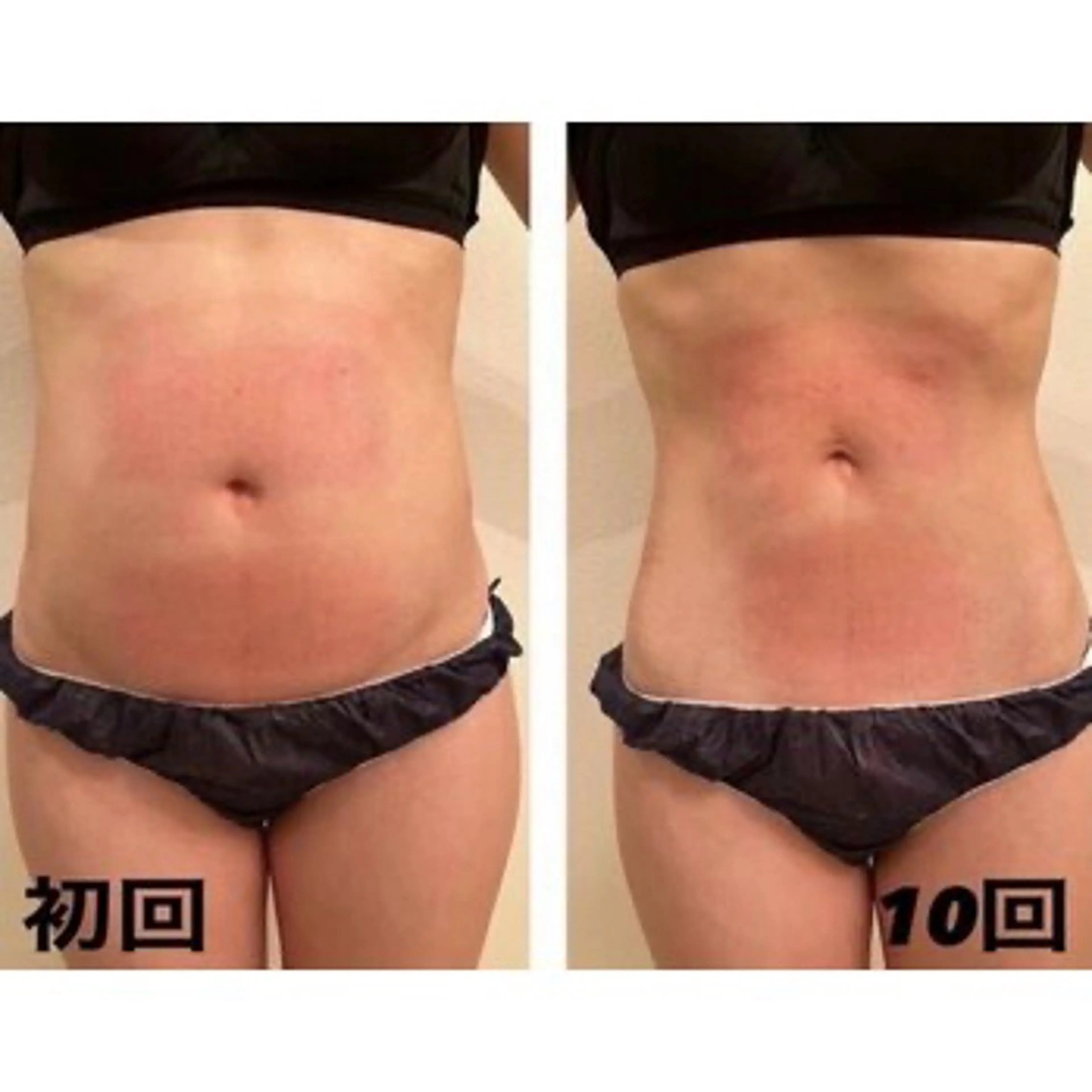 【2箇所】❄️-12℃冷却痩身❄️の写真