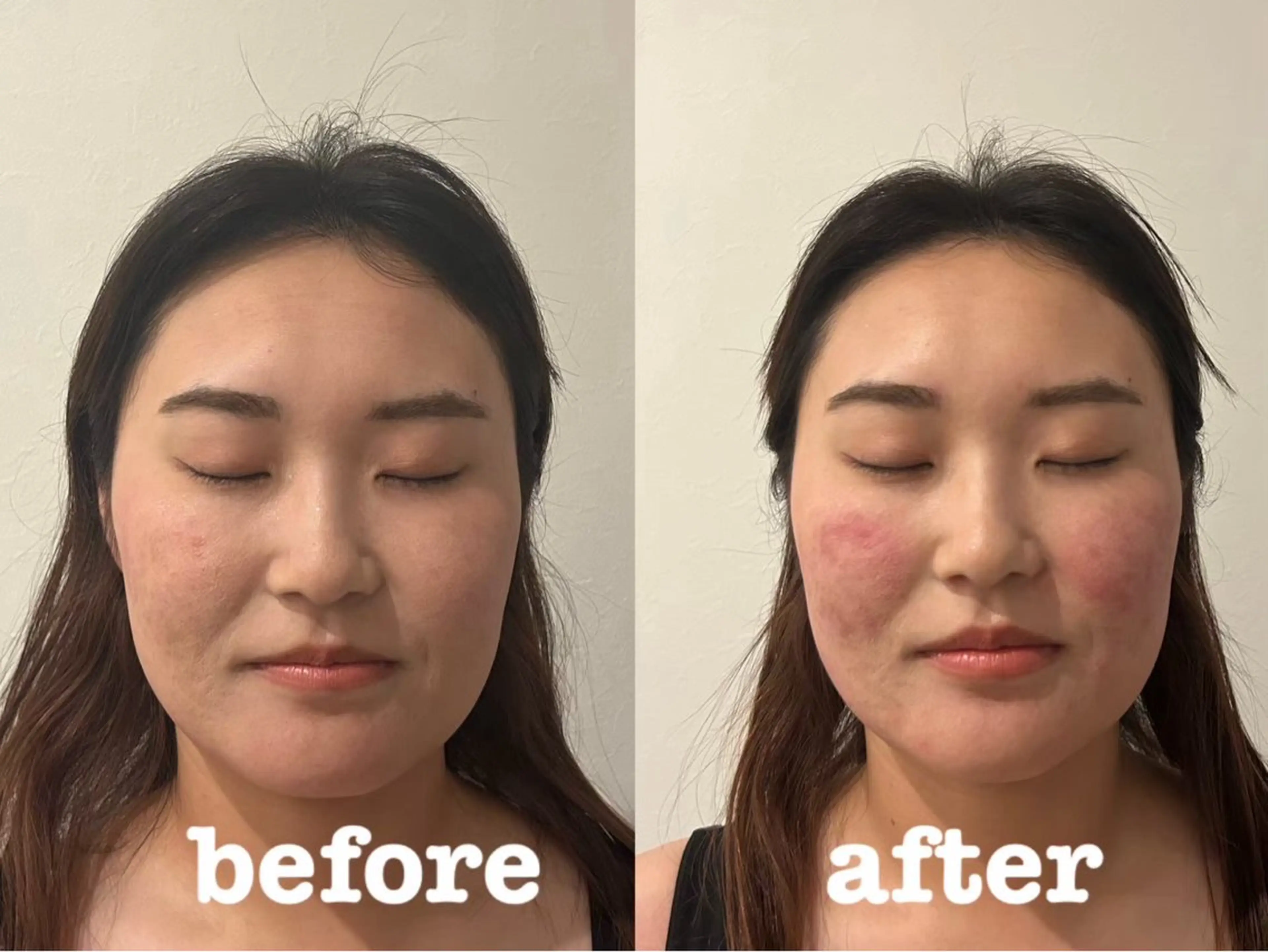 エステ リラク 美容鍼灸Solana所属・肌質改善×美容鍼 ゆいのエステ・リラクイメージ