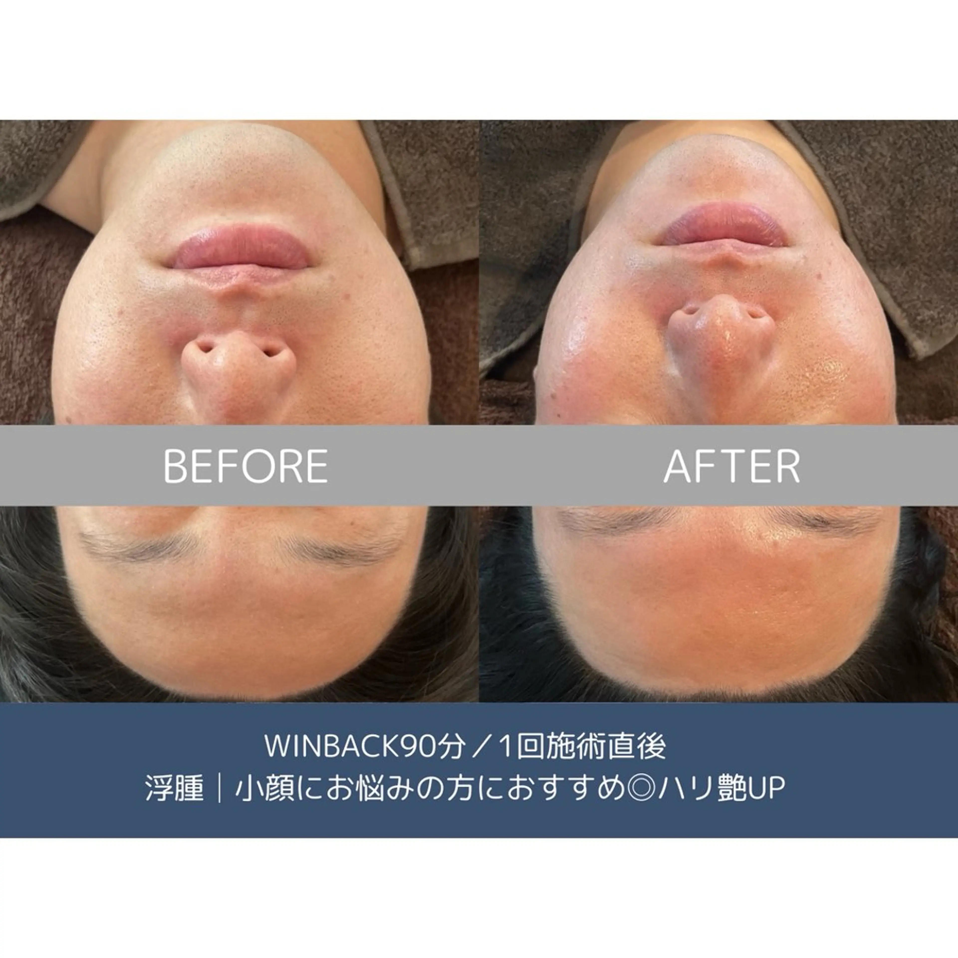 エステ リラク 艶肌ハーブピーリング /毛穴洗浄のエステ・リラクイメージ