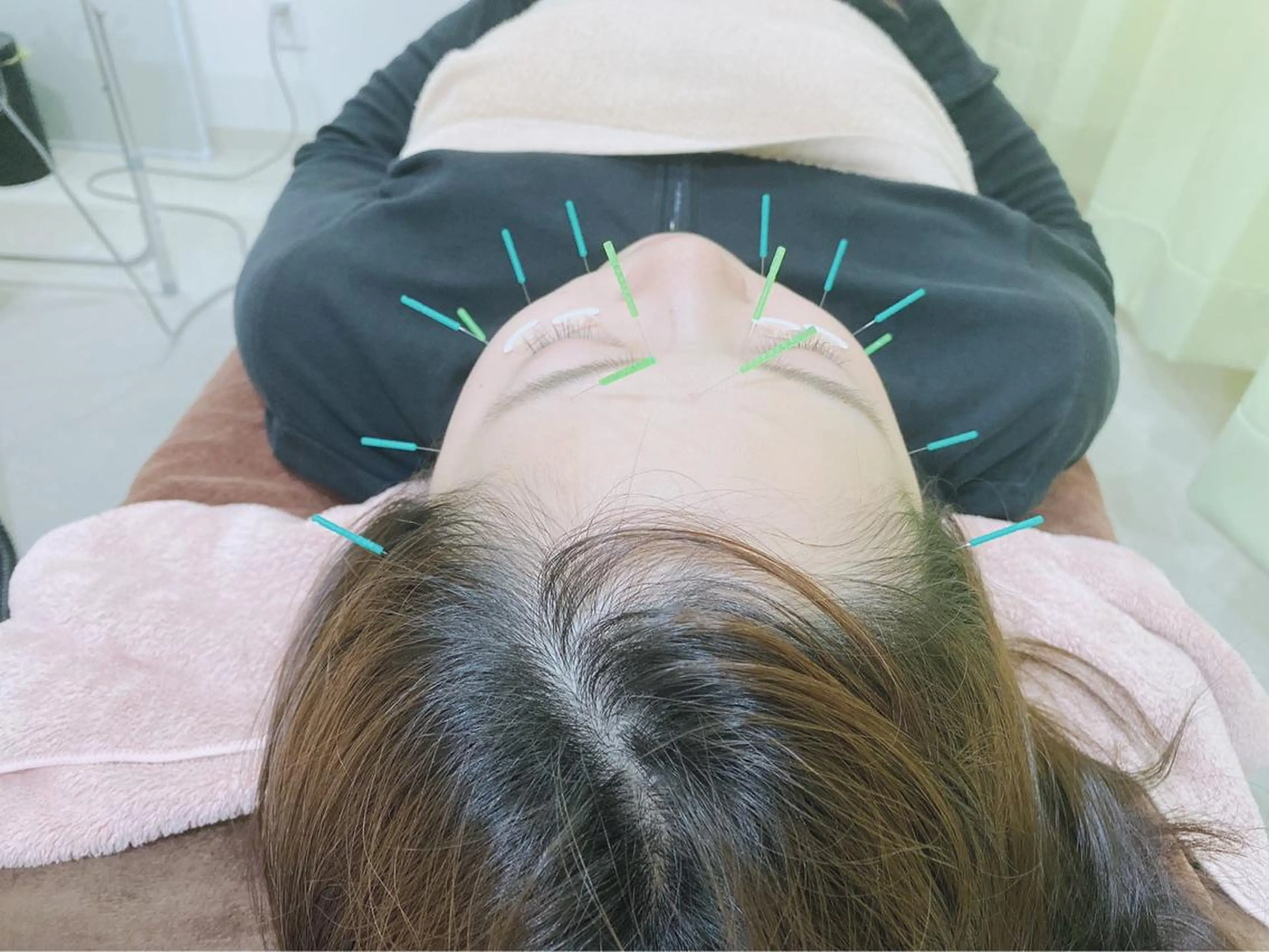 美容鍼スタンダード【美容鍼が初めての方にオススメ✨】の写真