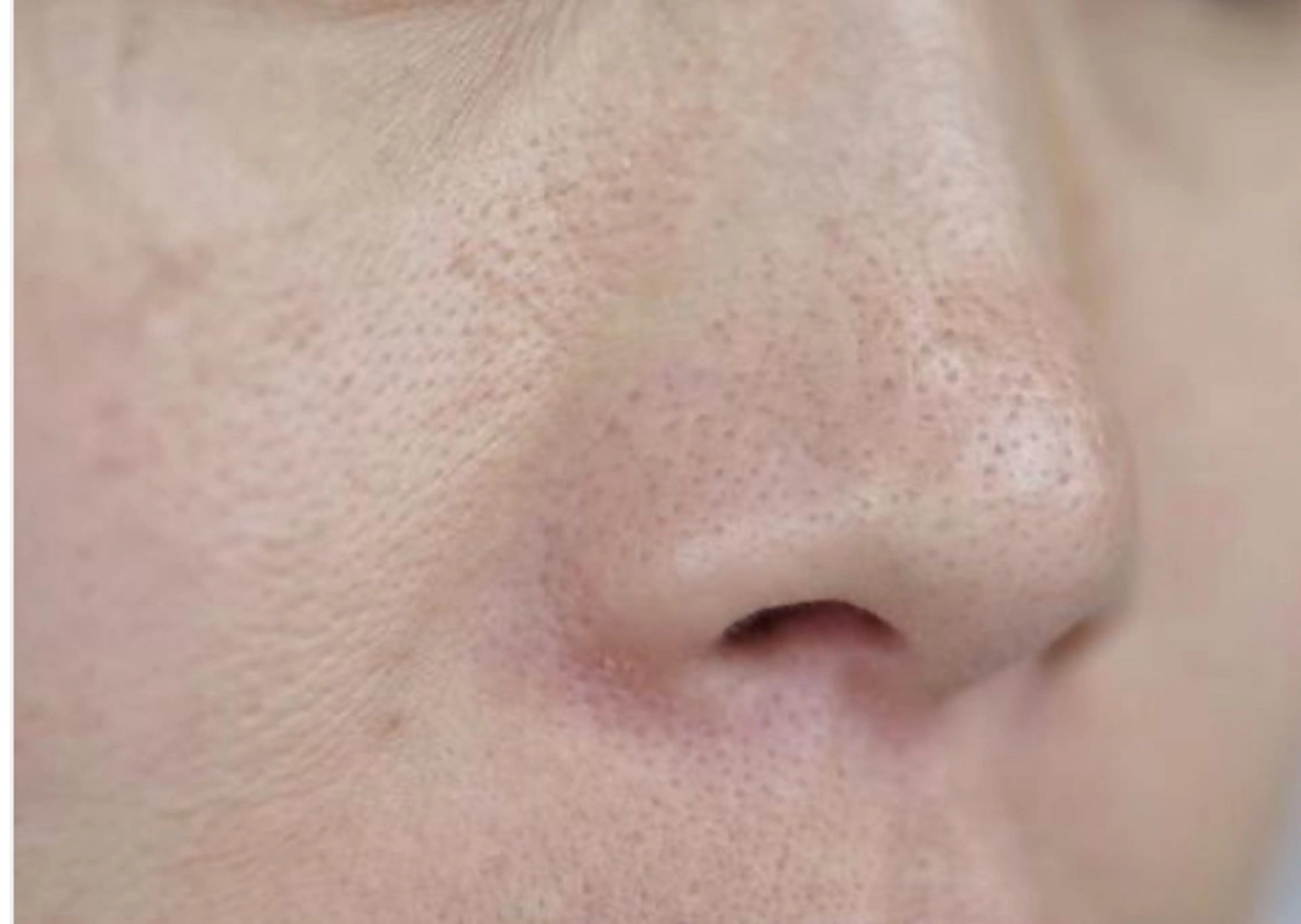 【毛穴レス肌育フェイシャル】の写真