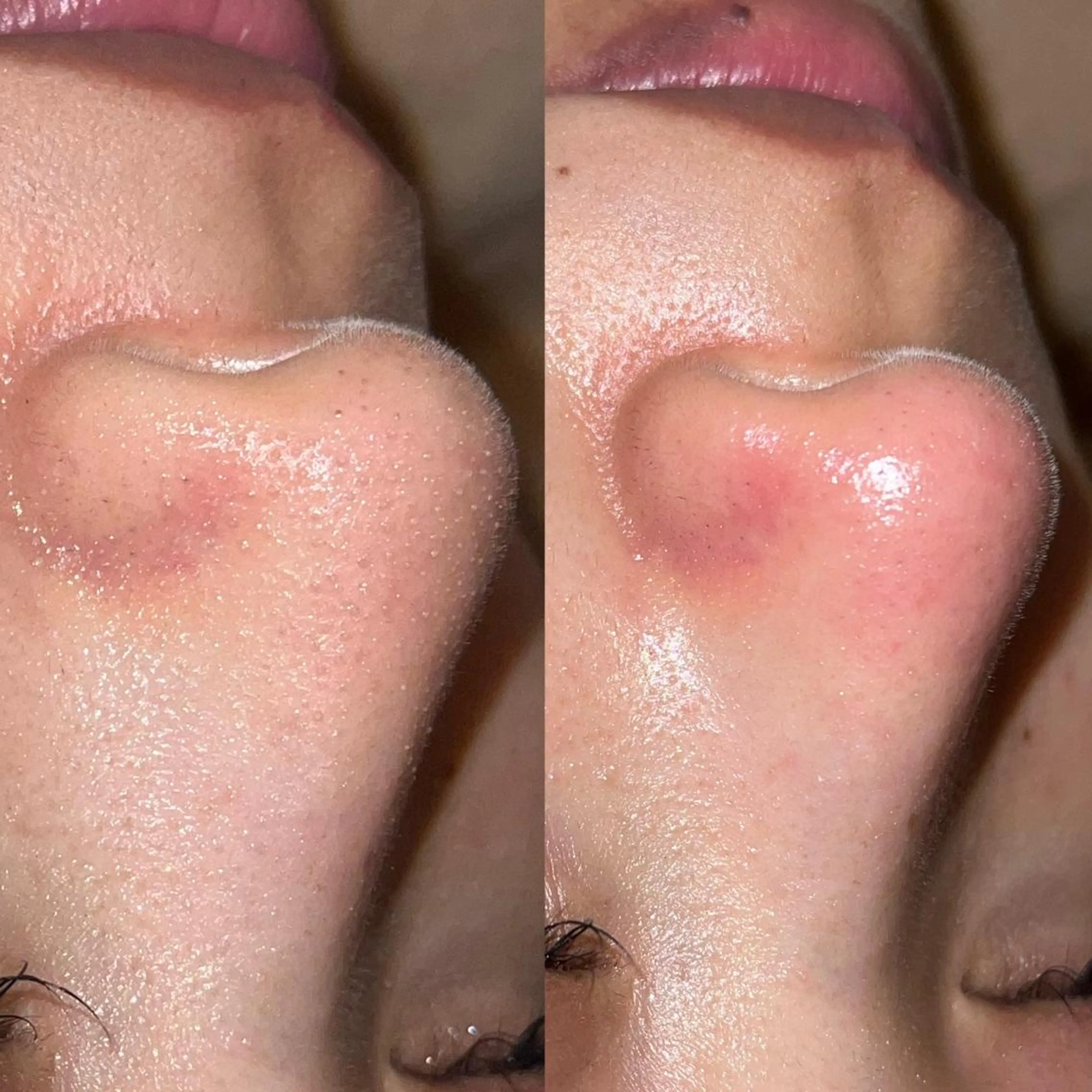 ハーブピーリング /毛穴ケア/脱毛/韓国ツヤ肌専門店【HARU.】所属・全身脱毛/韓国ツヤ肌 ハーブピーリングのエステ・リラクイメージ