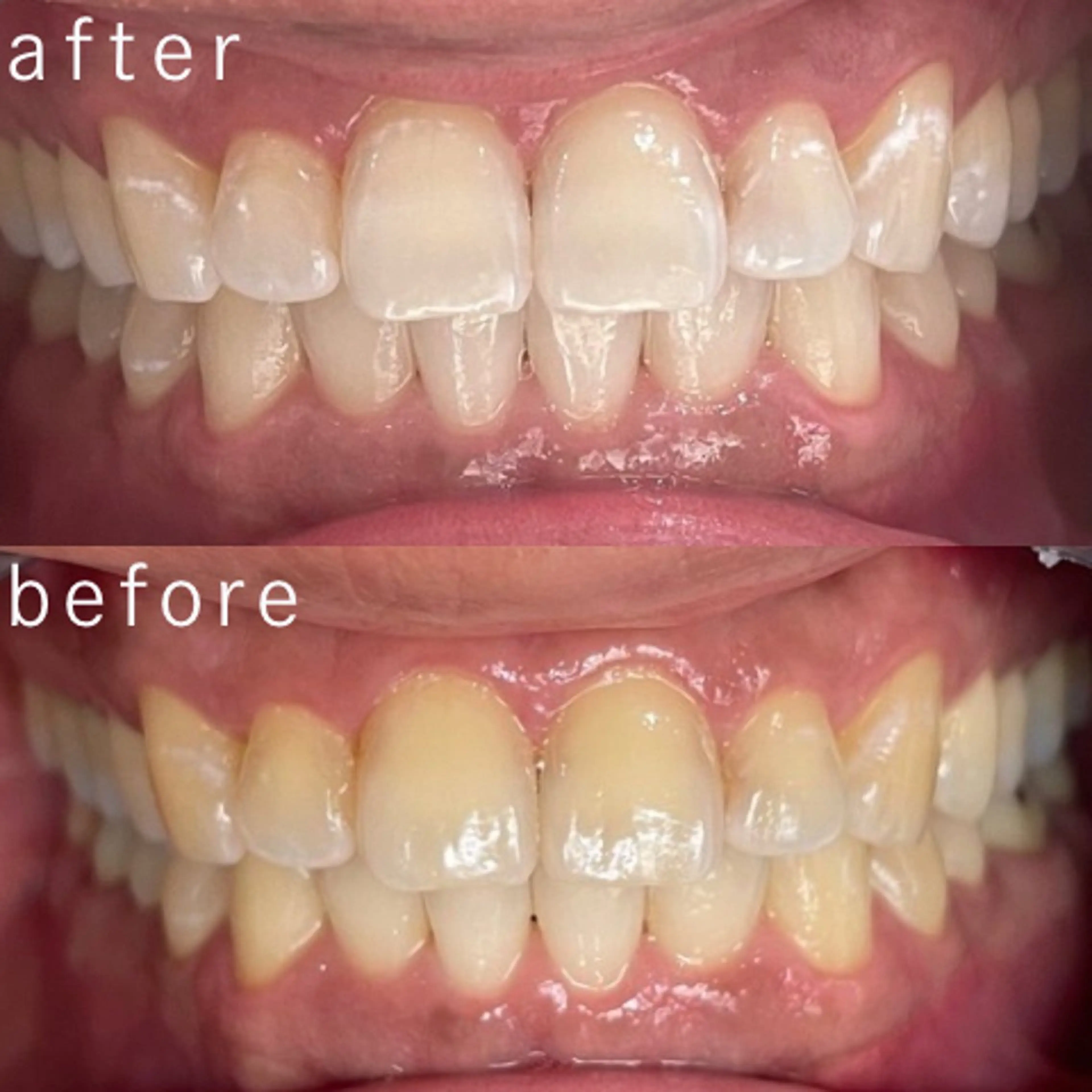 その他 サクッとホワイト都立大学店所属・セルフホワイトニング 都立大学🦷✴︎のその他イメージ