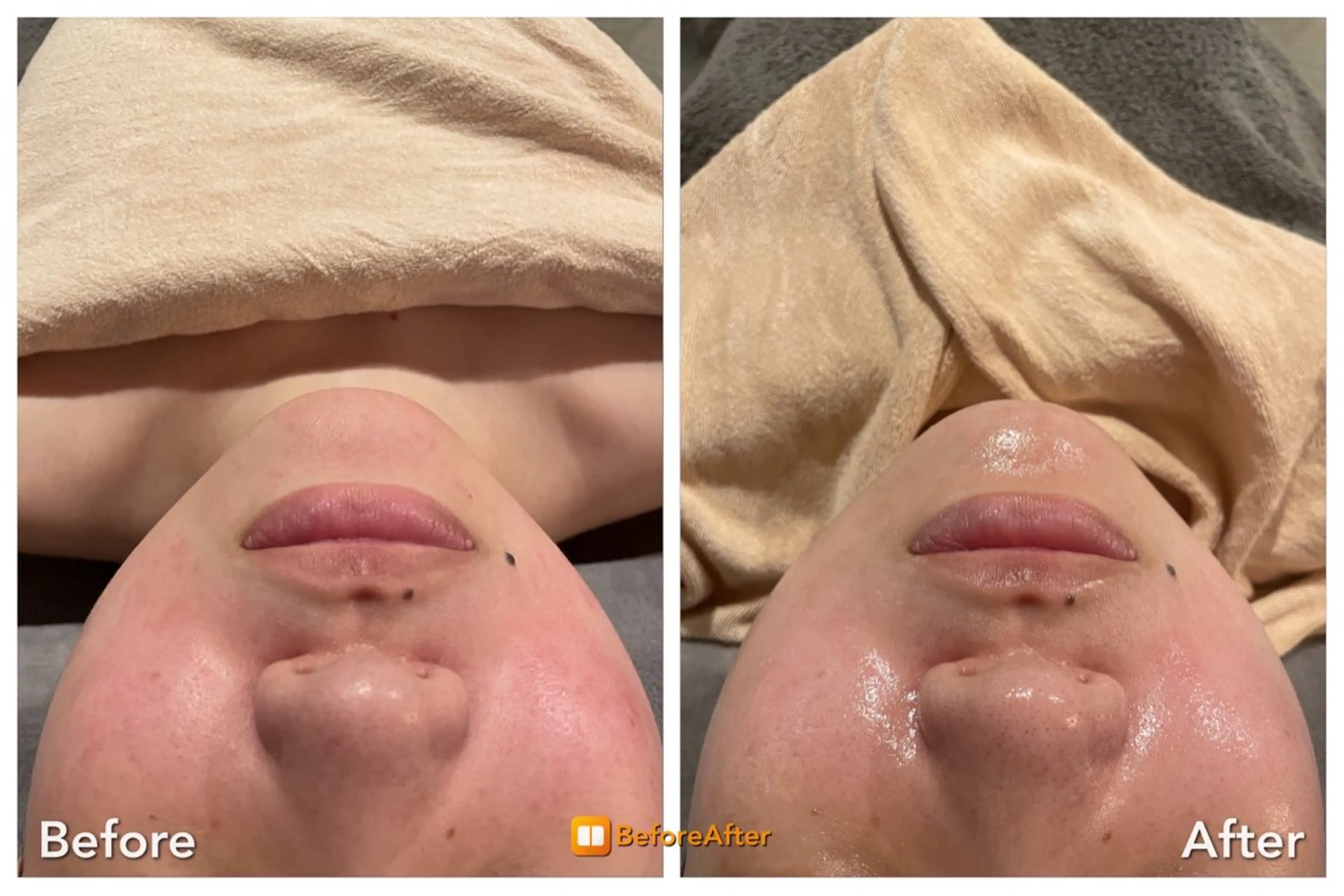 Meupニキビ専門店 背中/ハーブ/肌管理のその他イメージ