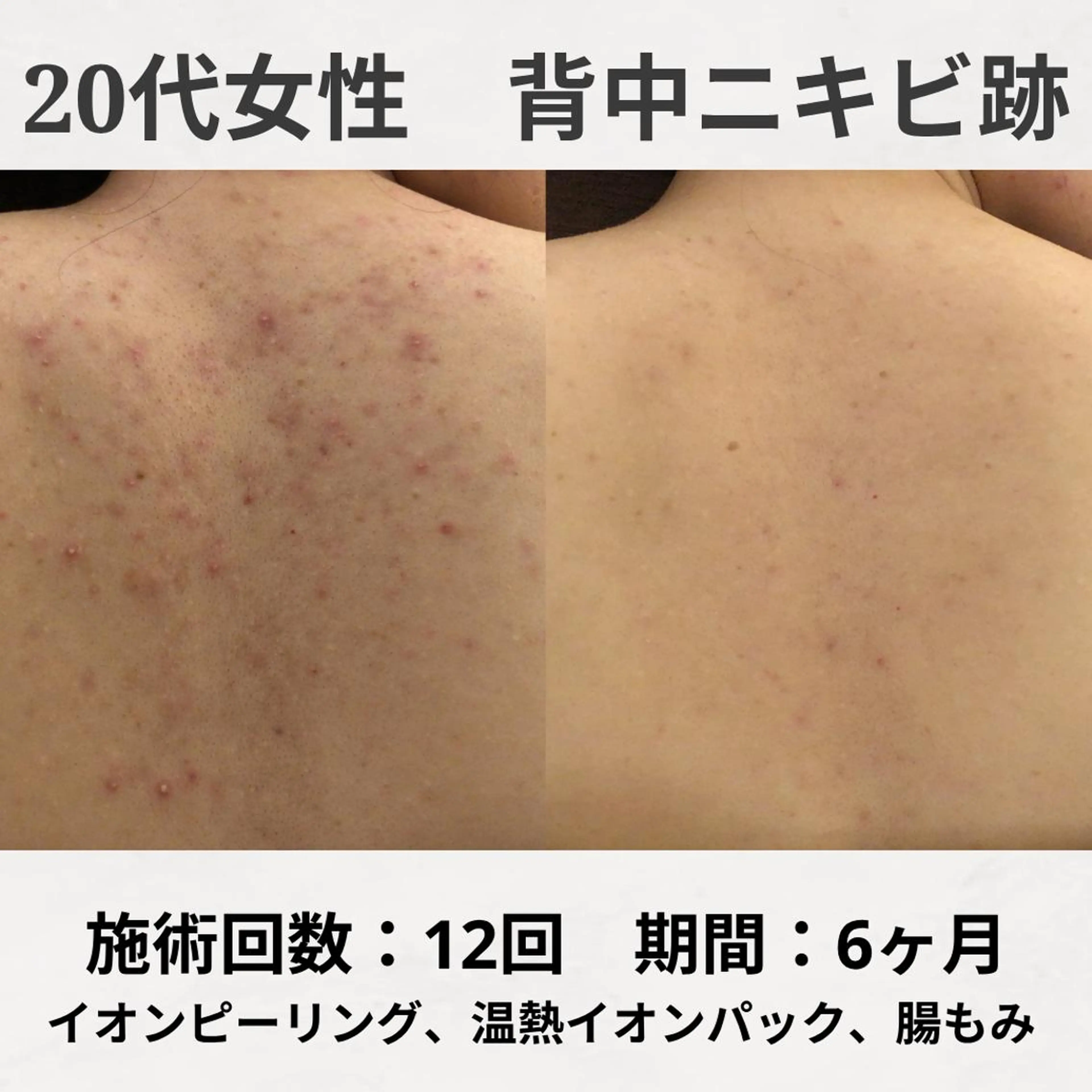 ニキビ跡改善専門🔥 医療にはできない改善のエステ・リラクイメージ