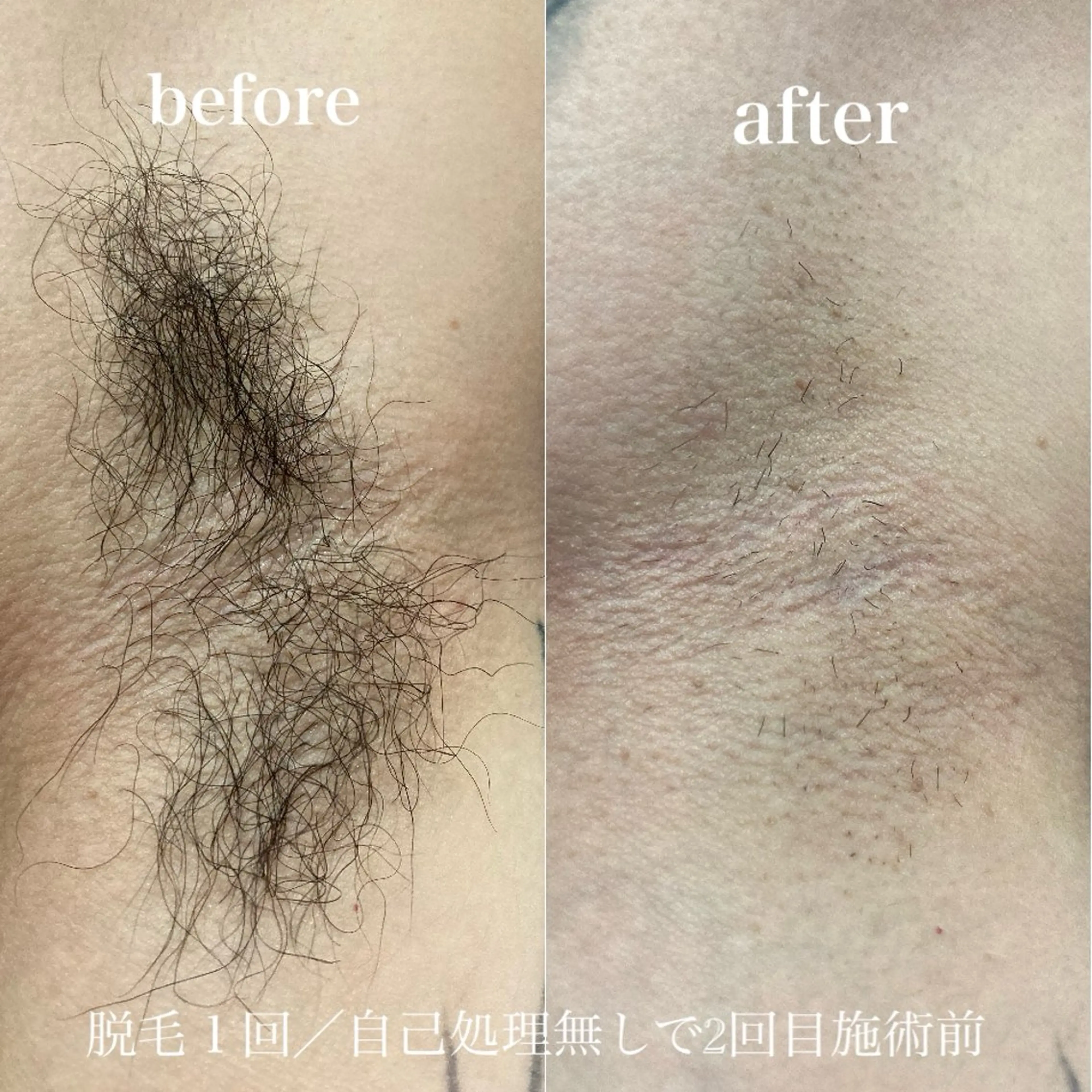 一期一会に感謝💓お得に全身ツルツル！の写真