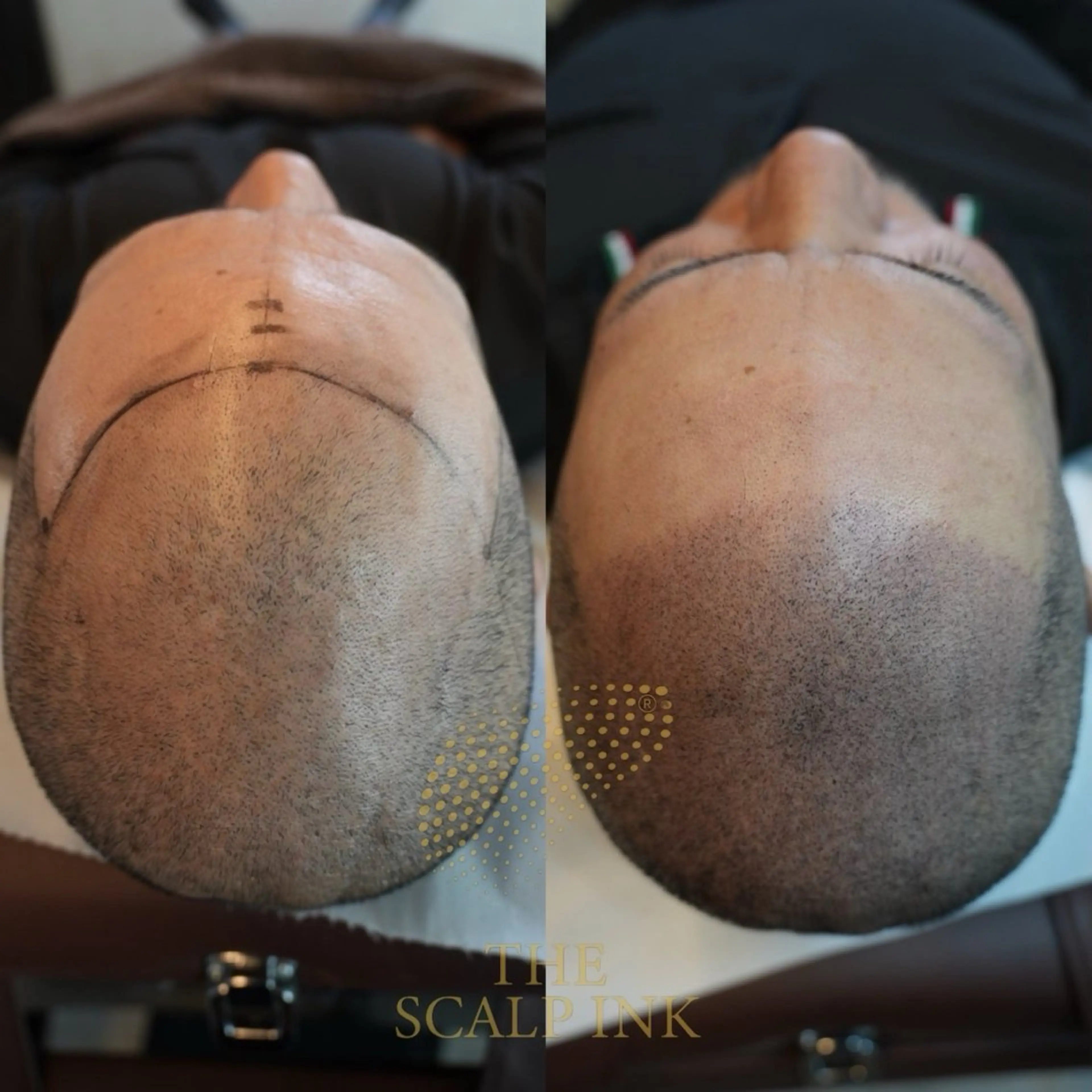 スカルプインク100000発⭐️モニター価格⭐️の写真