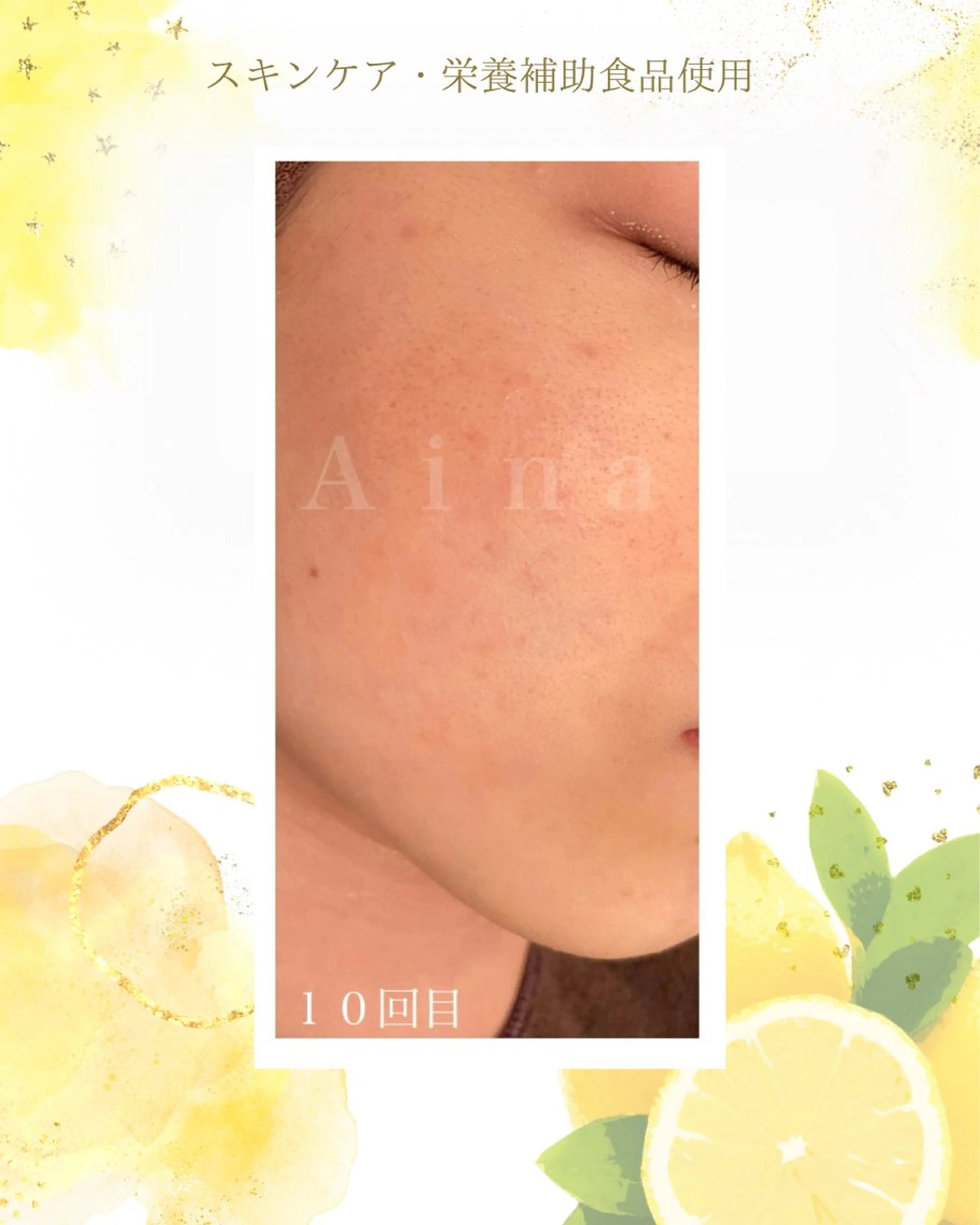 エステ リラク ニキビ跡専門サロン Ａｉｎａのエステ・リラクイメージ