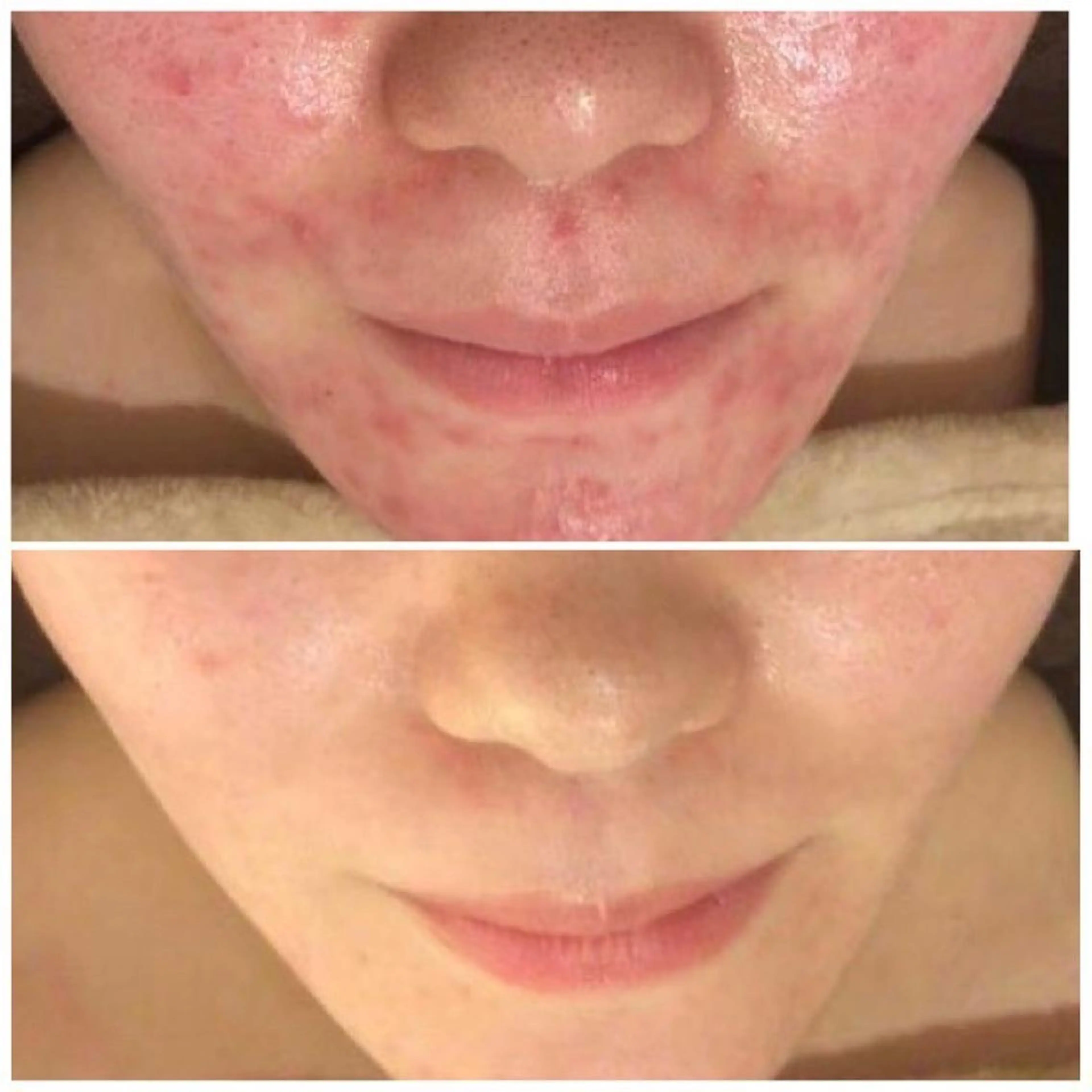 ロング カラー パーマ ヘアアレンジ メンズ キッズ ネイル マツエク・マツパ アイブロウ エステ リラク ニキビ特化型エステ 🍋最短で肌質改善のエステ・リラクイメージ