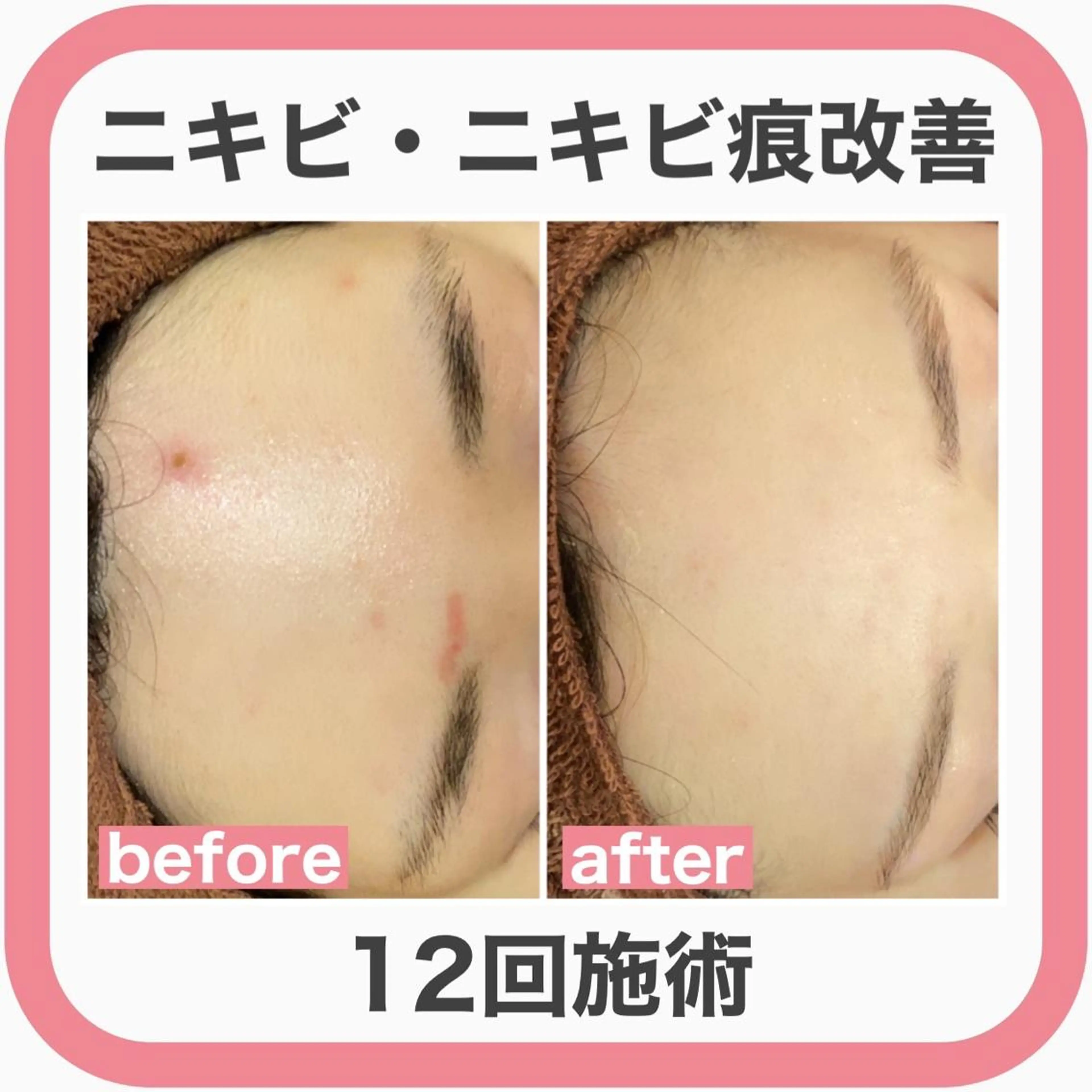 セミロング カラー パーマ ヘアアレンジ メンズ キッズ ネイル マツエク・マツパ アイブロウ 3か月で肌革命👼 ニキビ専門店💫のエステ・リラクイメージ