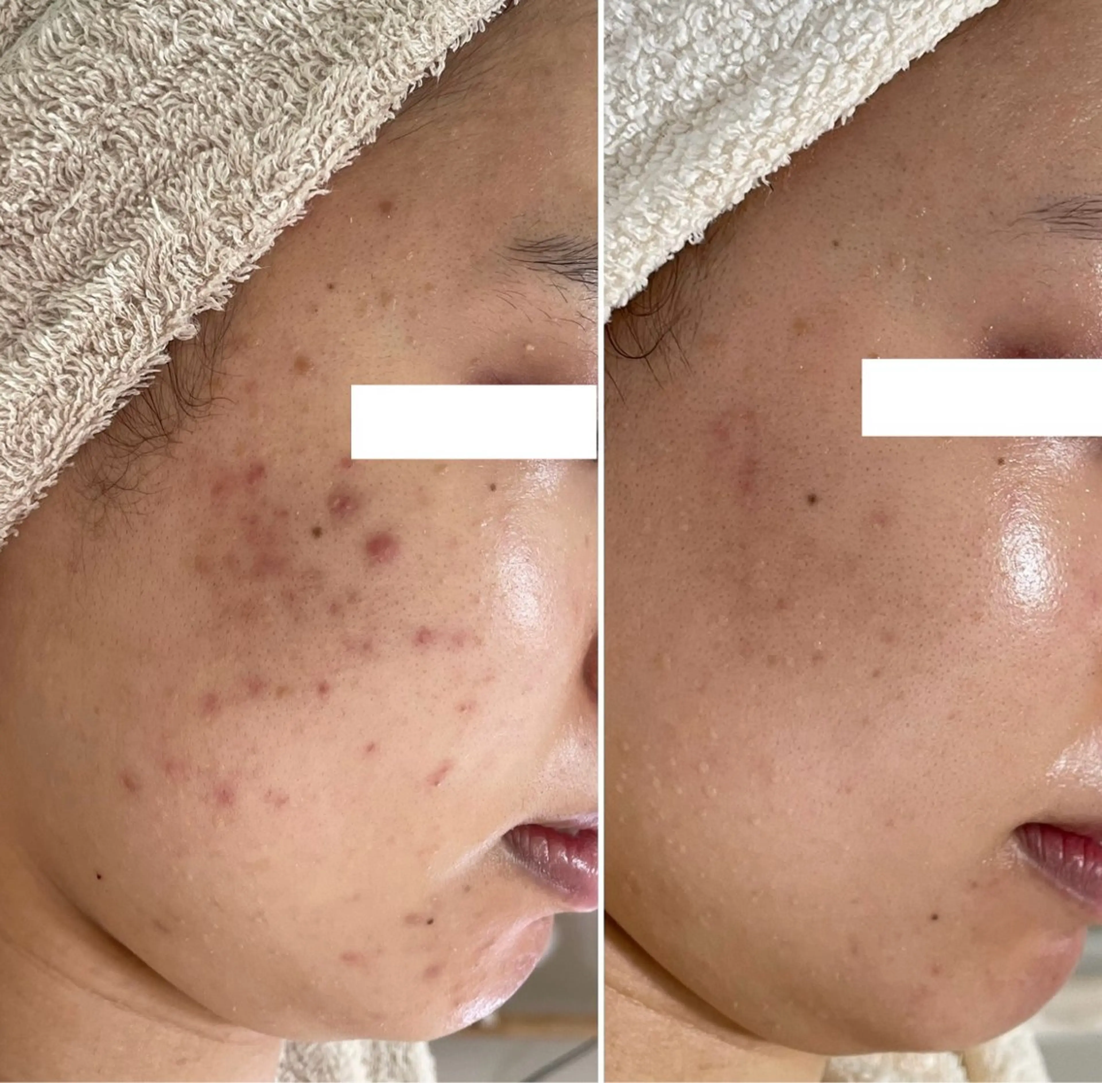 ニキビ・毛穴・ フェイシャル専門店のエステ・リラクイメージ