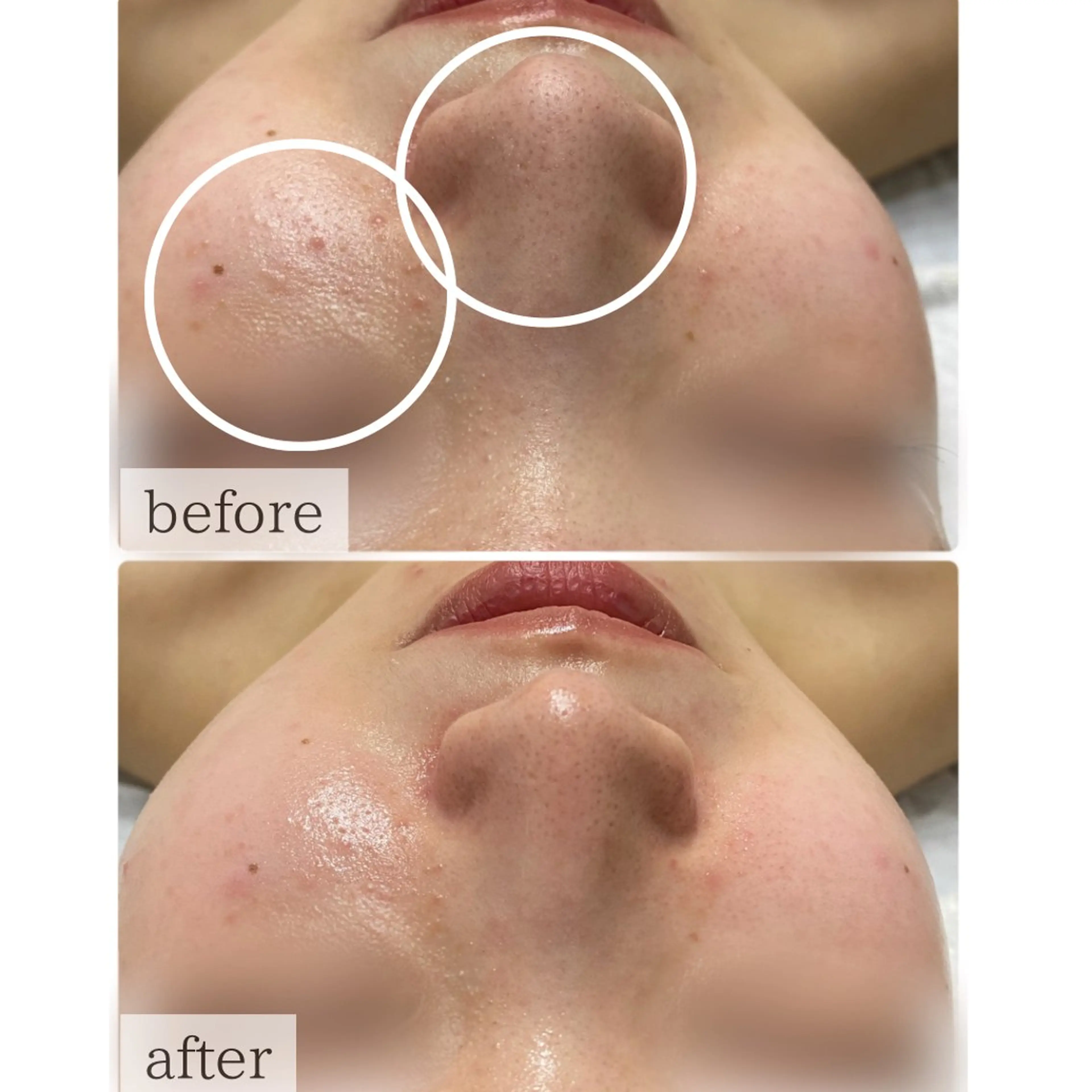 ハーブピーリング🌹 Homieのエステ・リラクイメージ