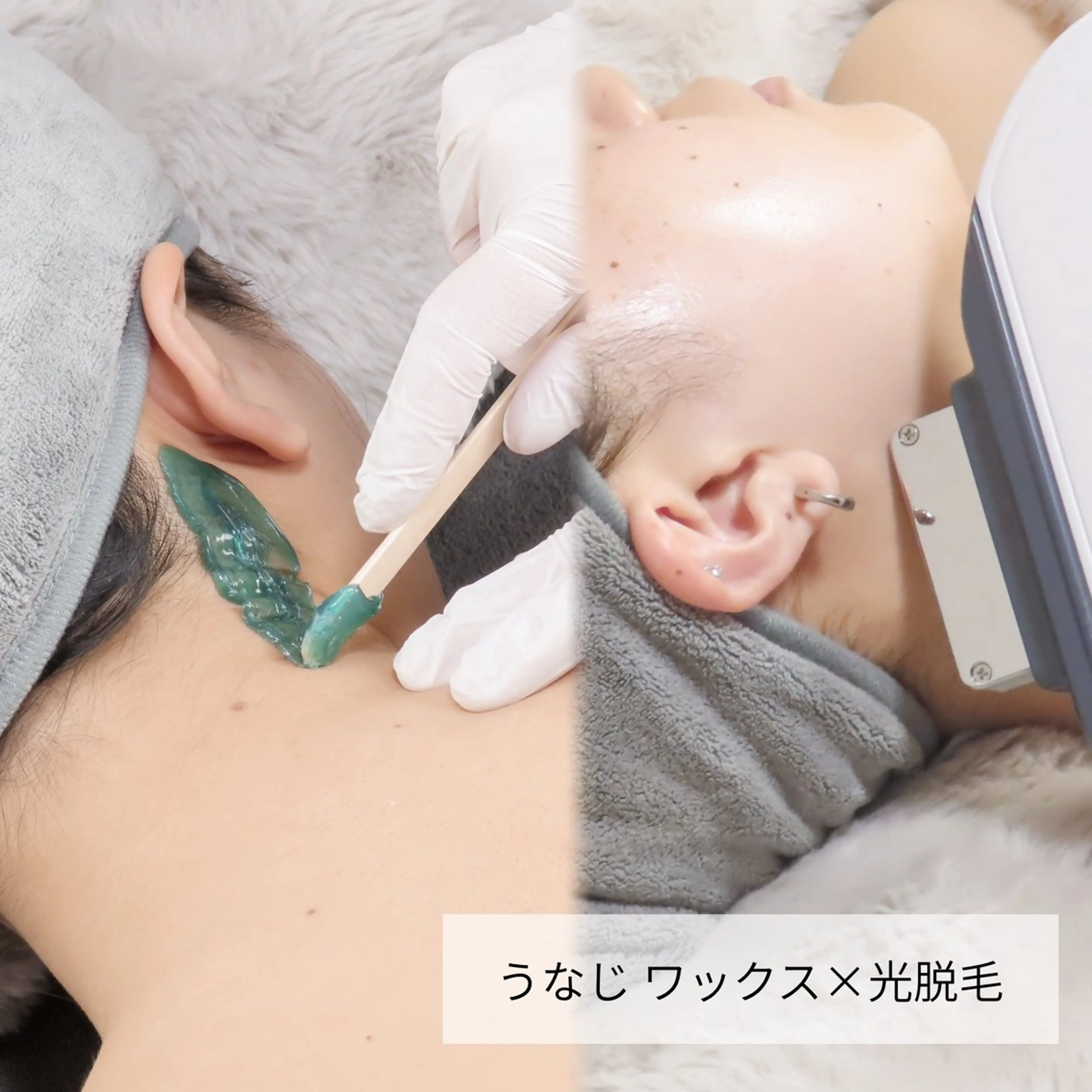 うなじワックス脱毛＋光脱毛照射 ¥7,000→¥4,000の写真