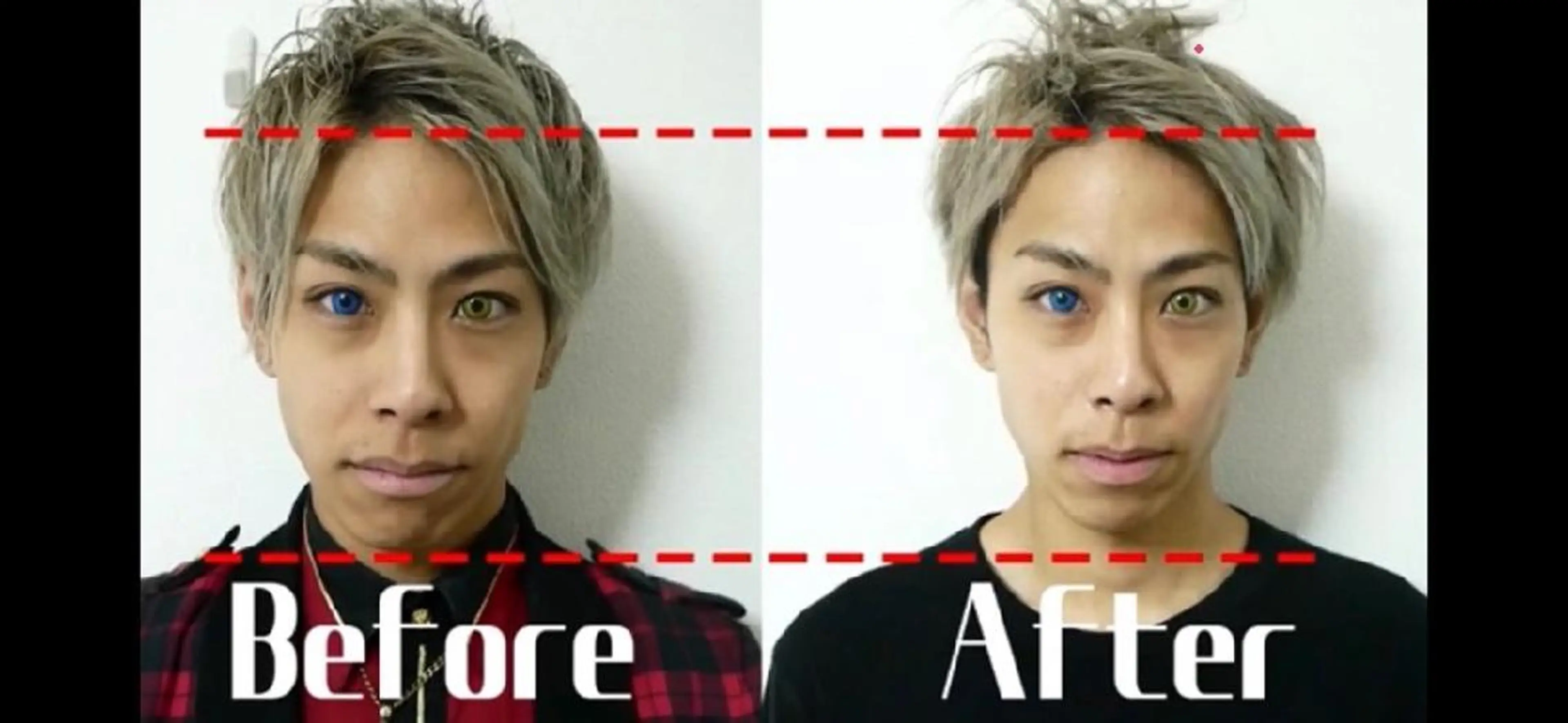 メンズ 医療提携Ruby小顔 ハーブピーリングのその他イメージ