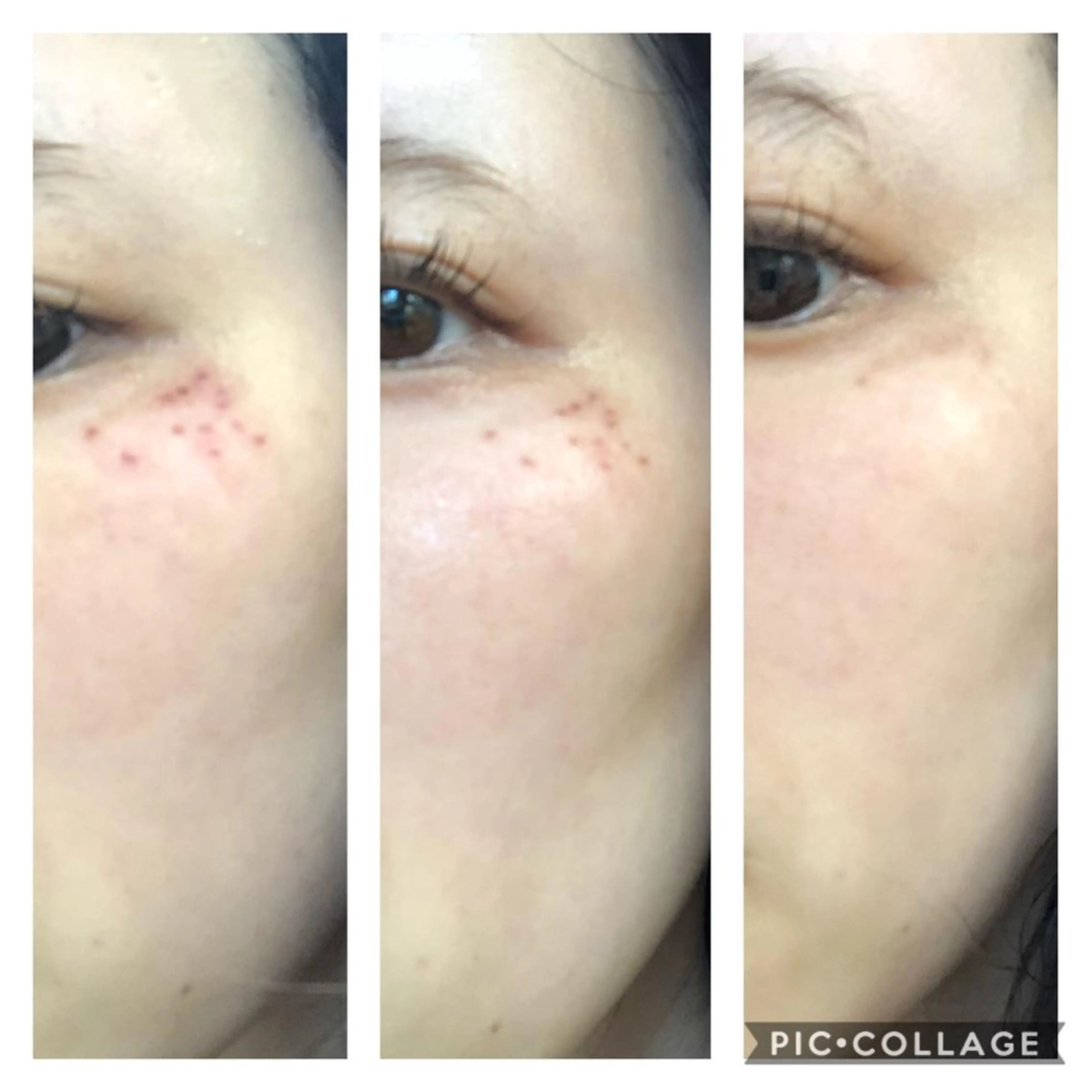 エステ ピーリングケア 🤍moekoのエステ・リラクイメージ