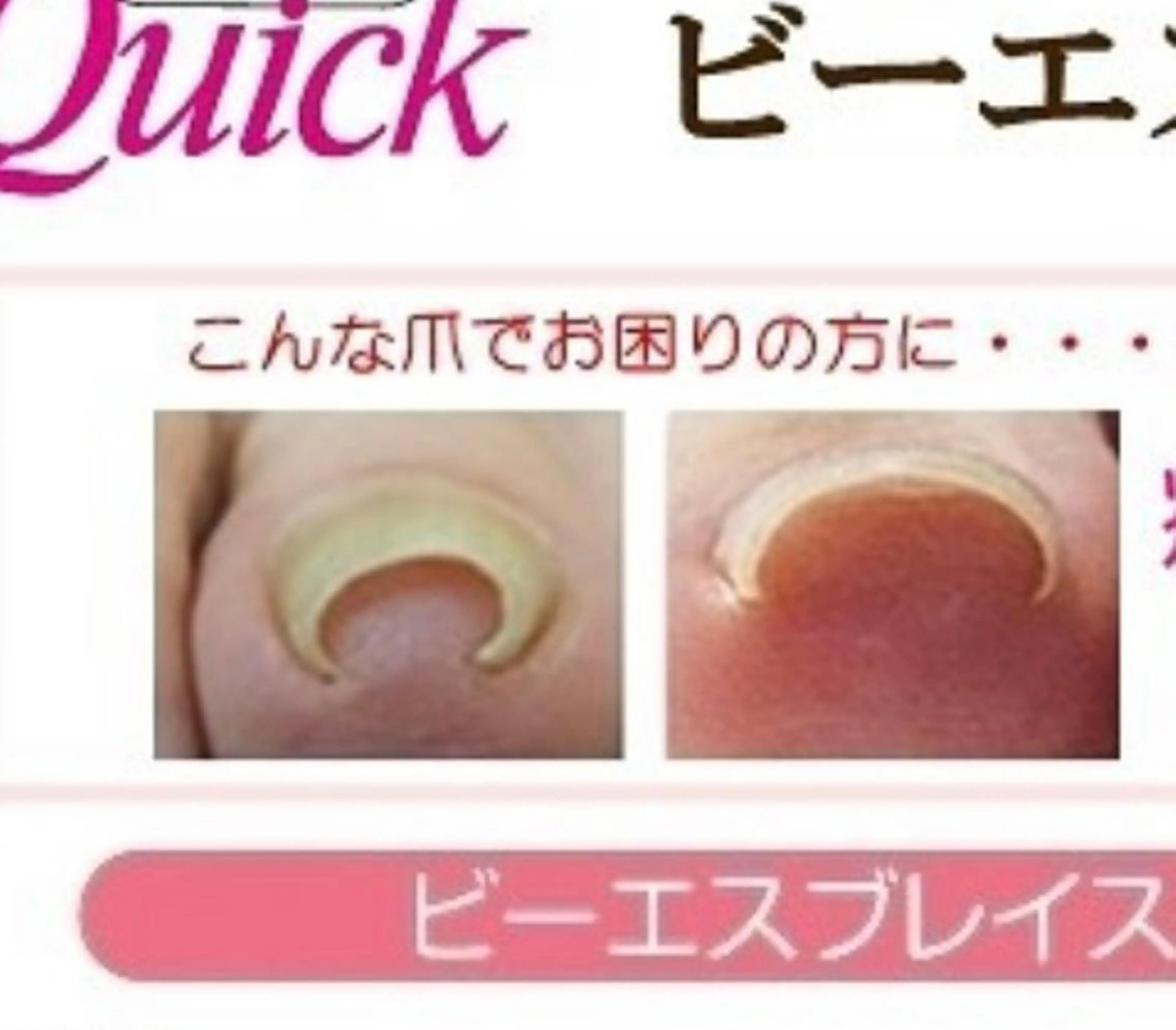 🦶巻き爪矯正(BSブレイスクイック)両親指の写真