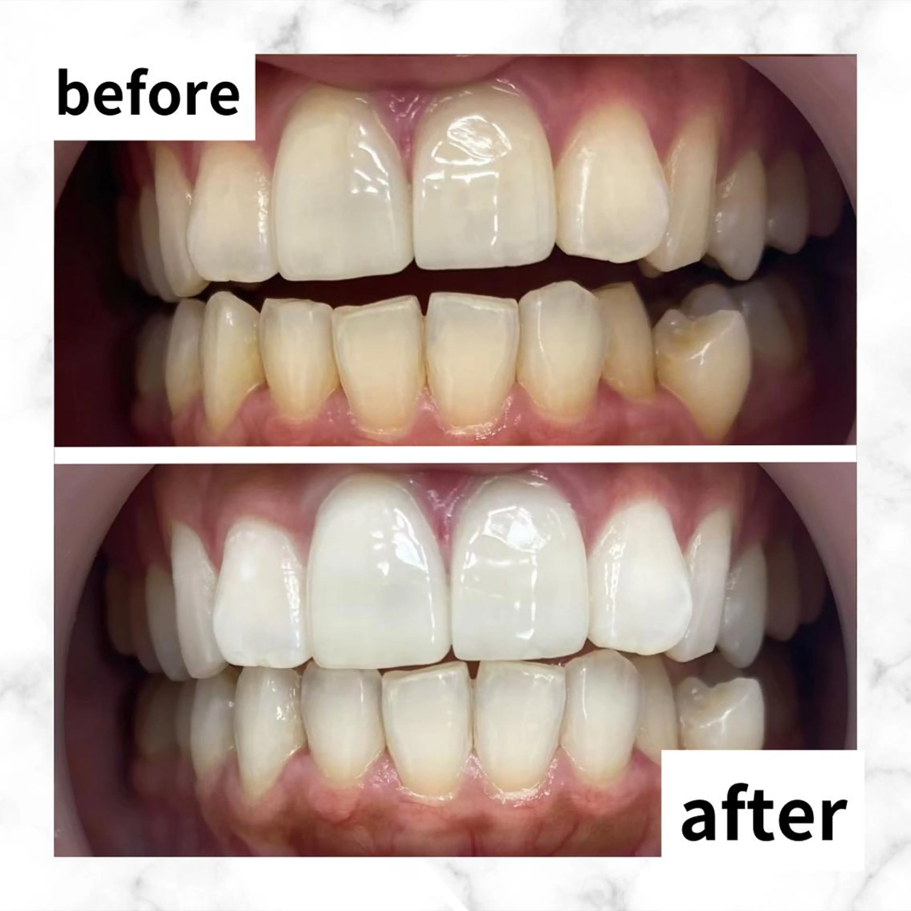 【👑人気No.1👑】5分照射×2回✨照射パワー2倍の最新高速セルフホワイトニングで時短ホワイトニング🦷❣の写真