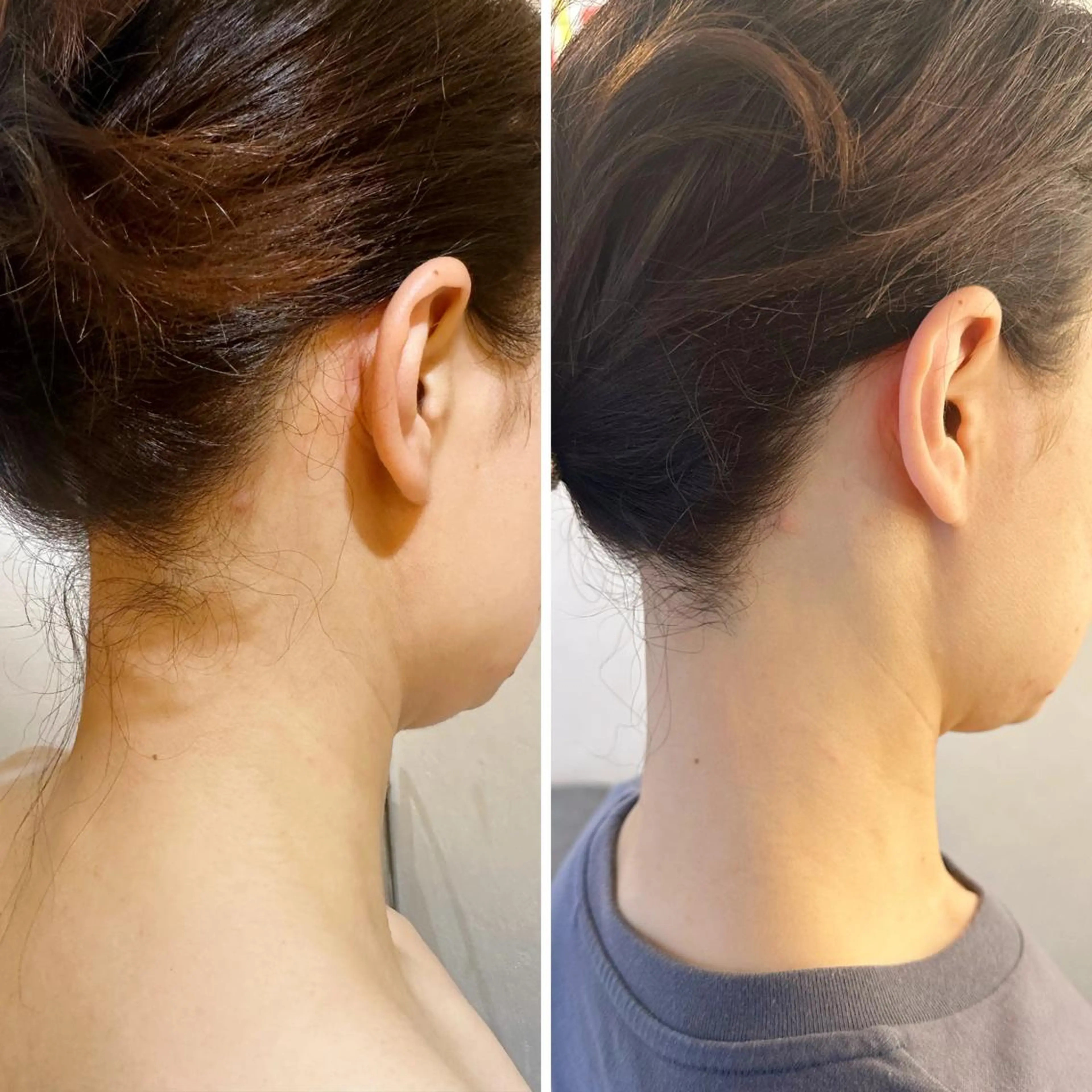 脱毛 うなじ脱毛/美肌脱毛 LABELのエステ・リラクイメージ