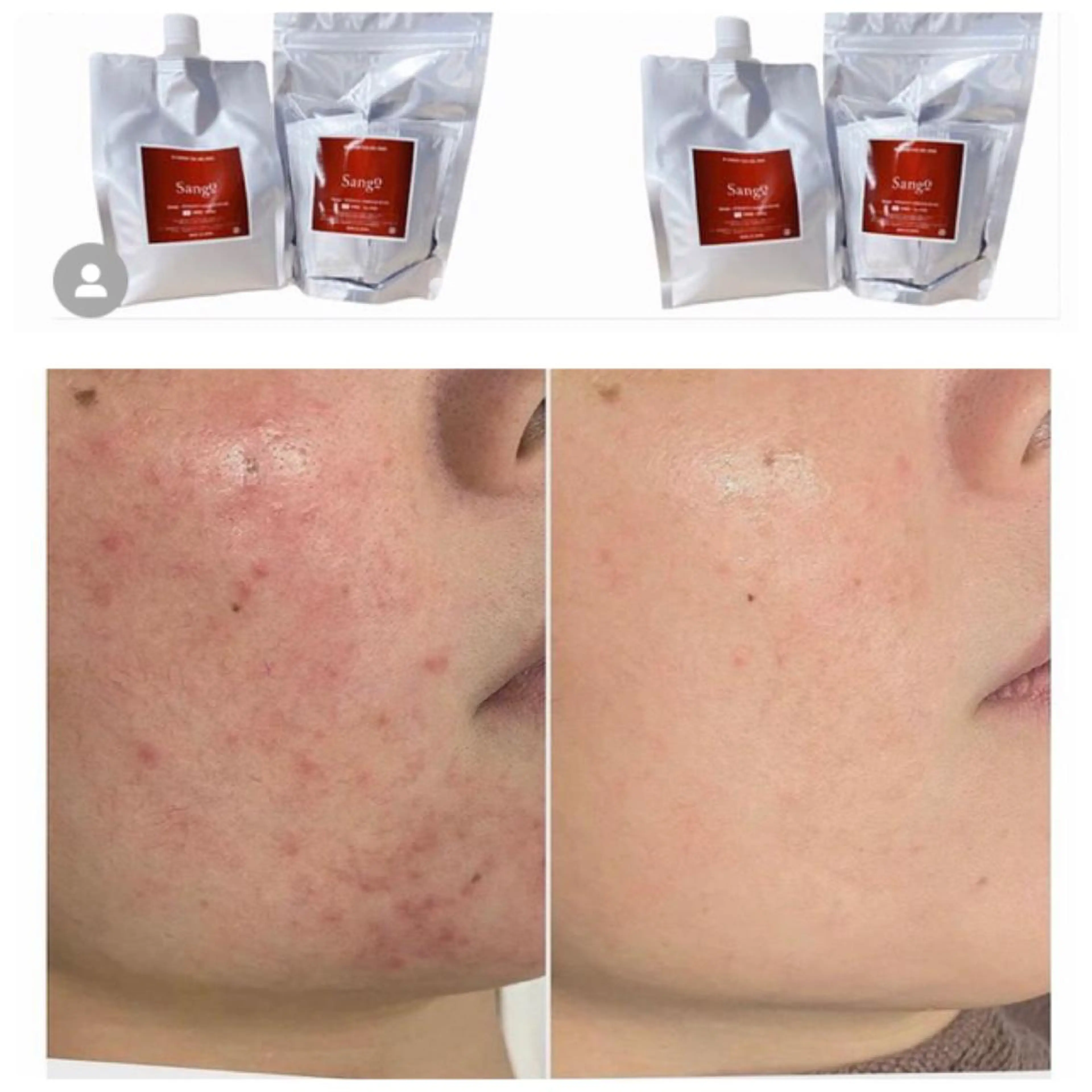 【国産ヒト幹細胞培養液配合】sango高濃度炭酸パック🌿ダブルエナジーCO2ジェルパックの写真