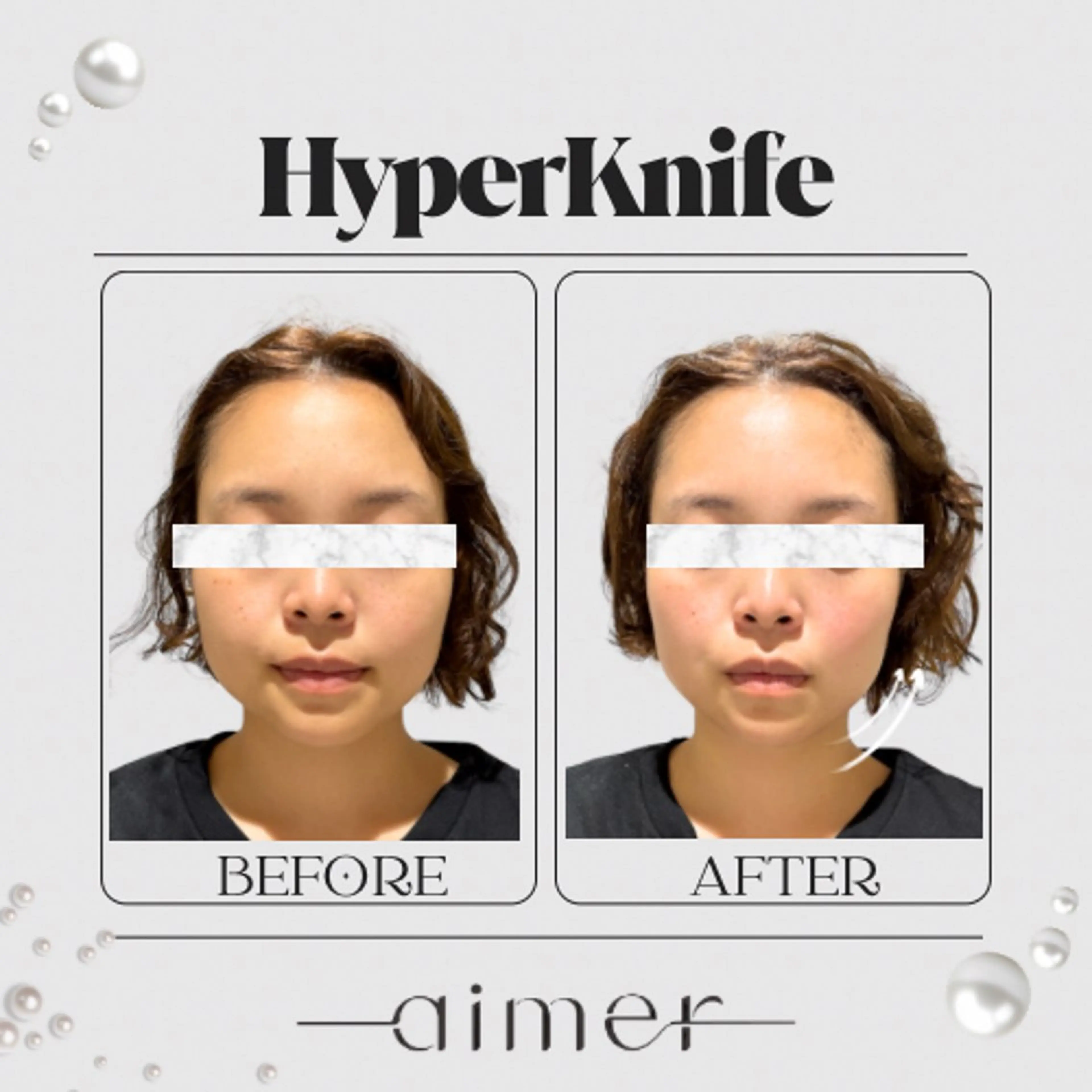 フェイシャルハイパーナイフ40分【デコルテ​〜​顔全体】浮腫｜コリ｜小顔の写真