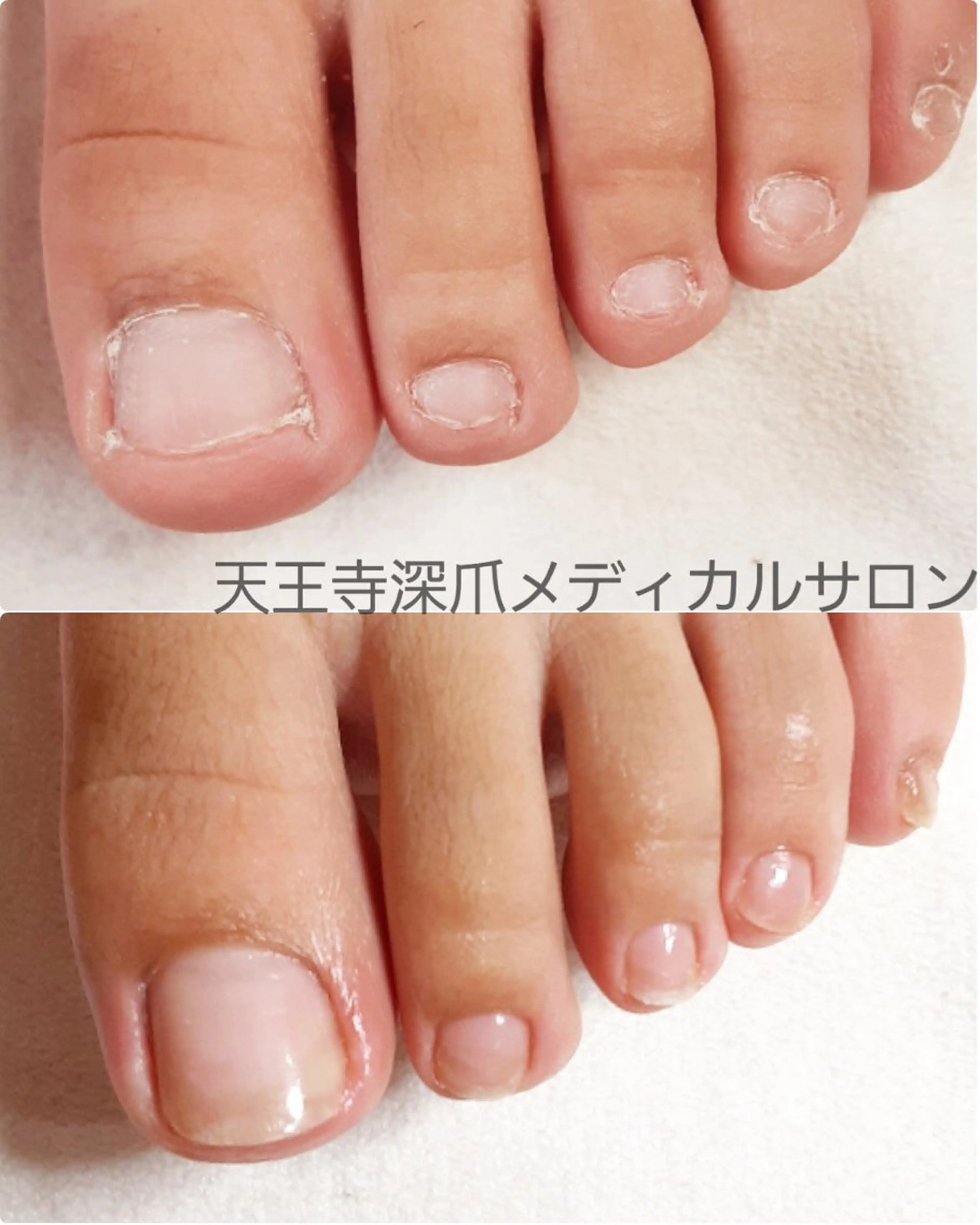 ネイル 天王寺 深爪メディカルサロンのネイルデザイン