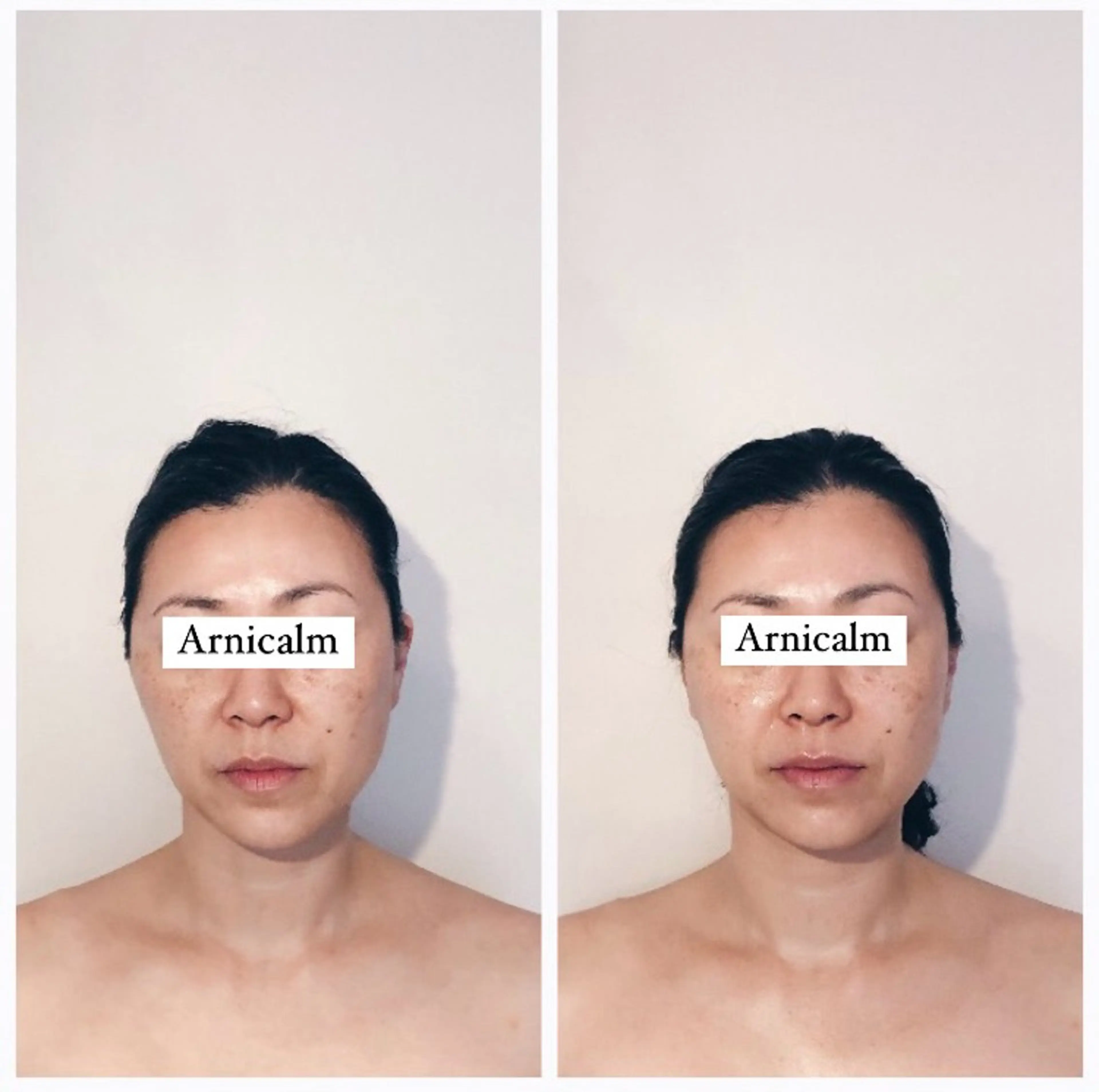 ハーブピーリング 肌再生ピーリング/のエステ・リラクイメージ