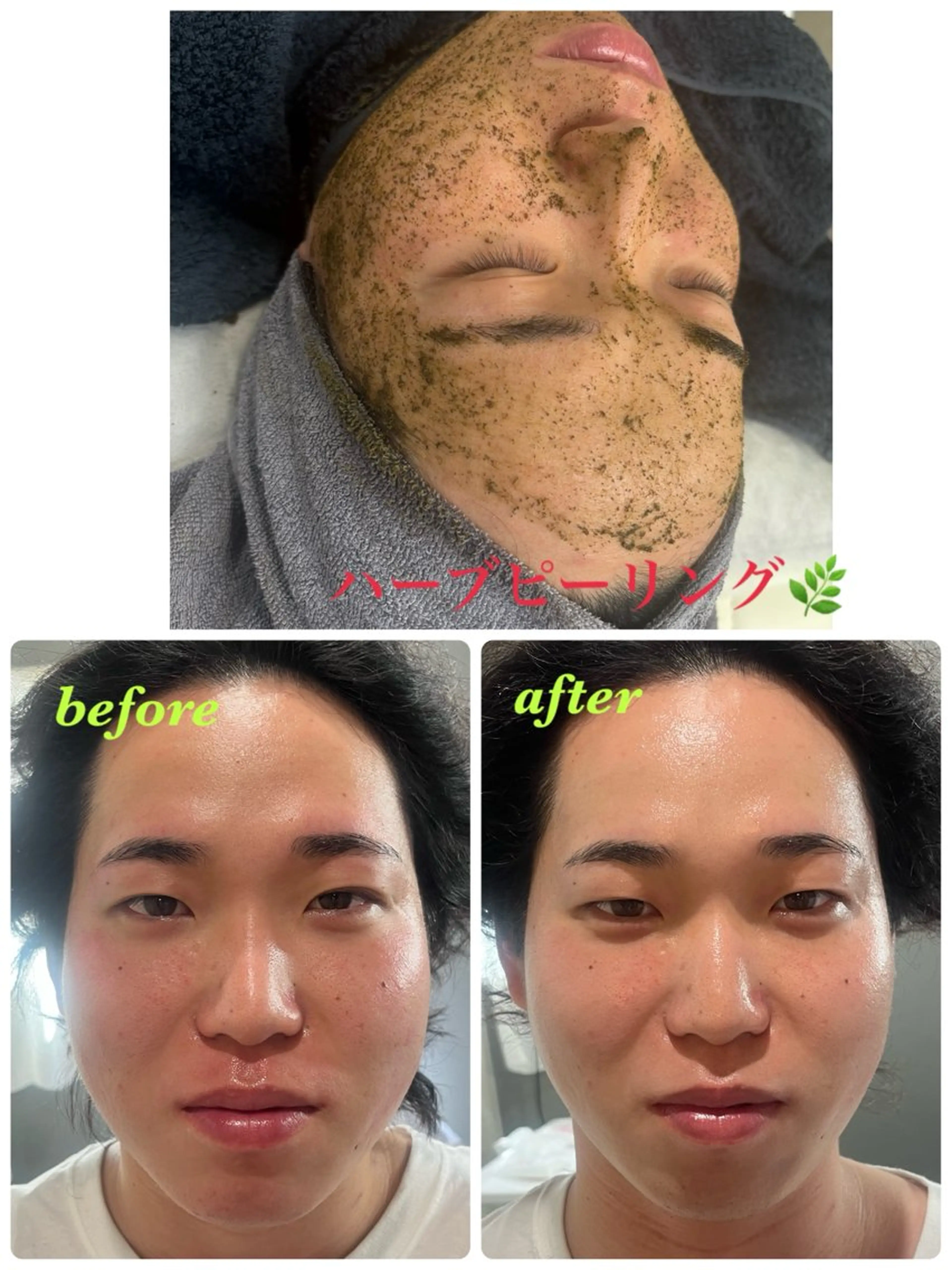 ハーブピーリング/韓国肌管理/フェイシャル/毛穴洗浄/眉毛/顔脱毛【糸脱毛専門】rev所属・ハーブピーリング専門 毛穴洗浄❤️眉waxのエステ・リラクイメージ