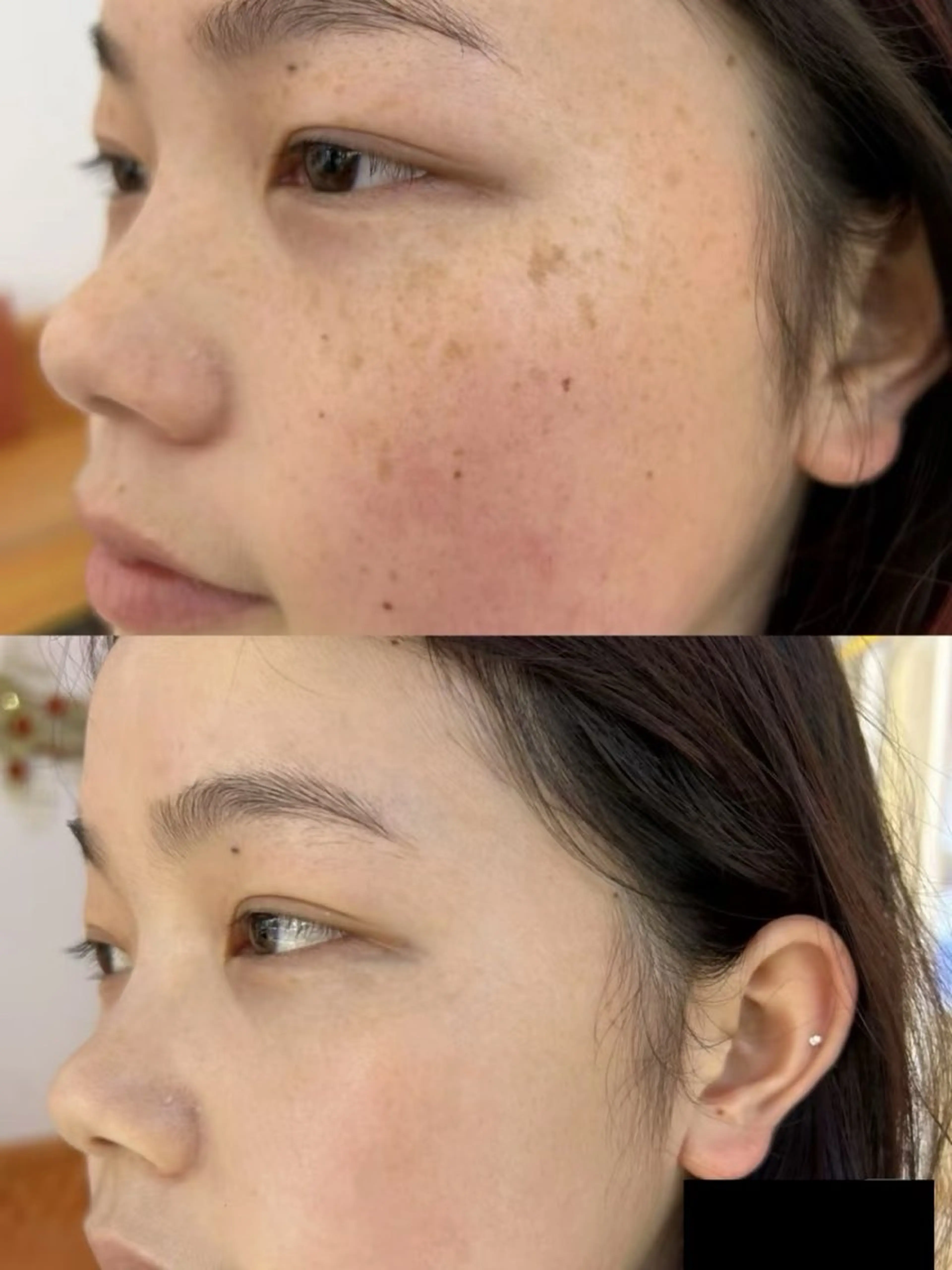 シミ、イボ、ホクが気になる方(2ミリ１ケ)の写真