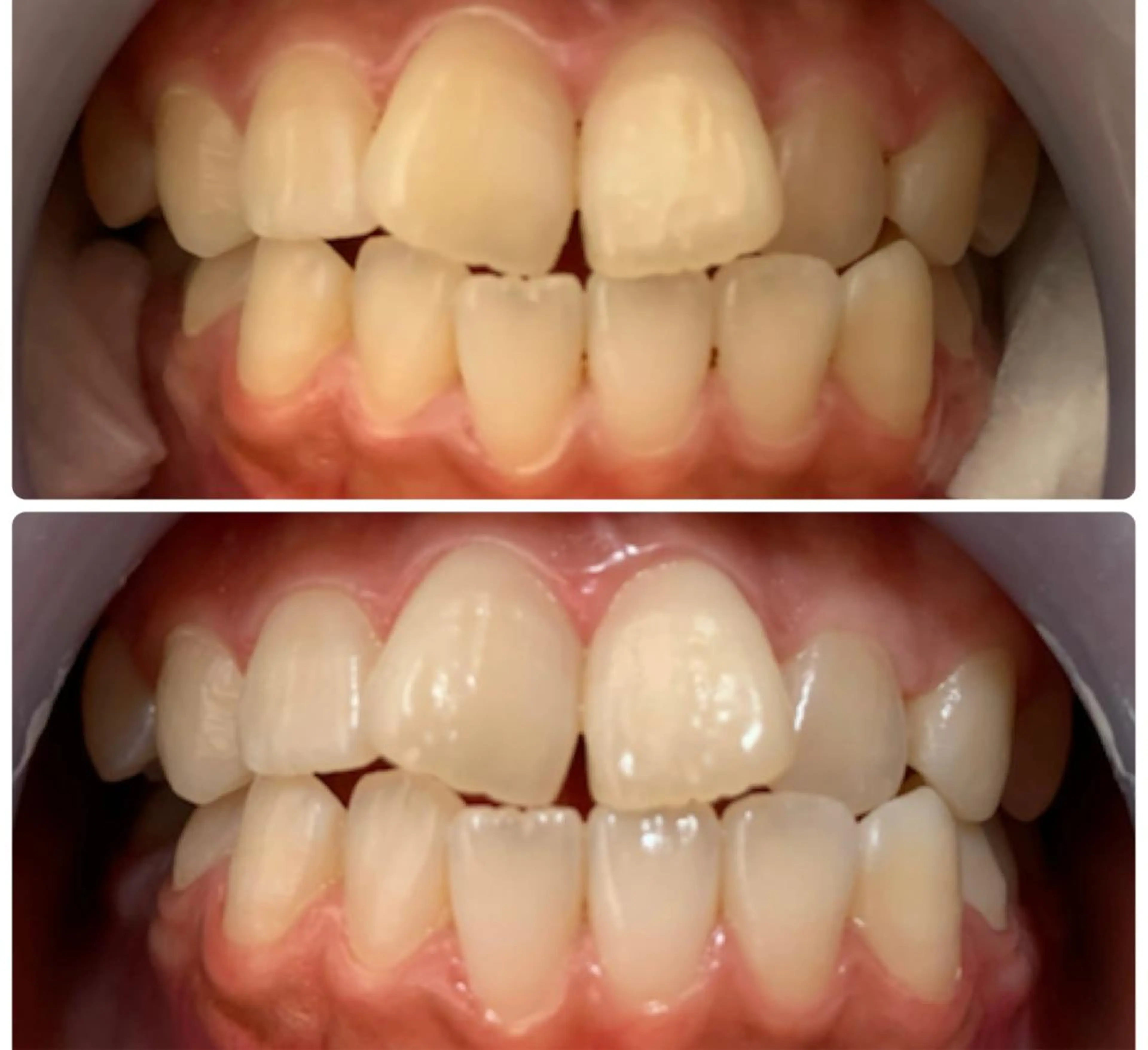 歯のセルフホワイトニング🦷《メンズ可》の写真