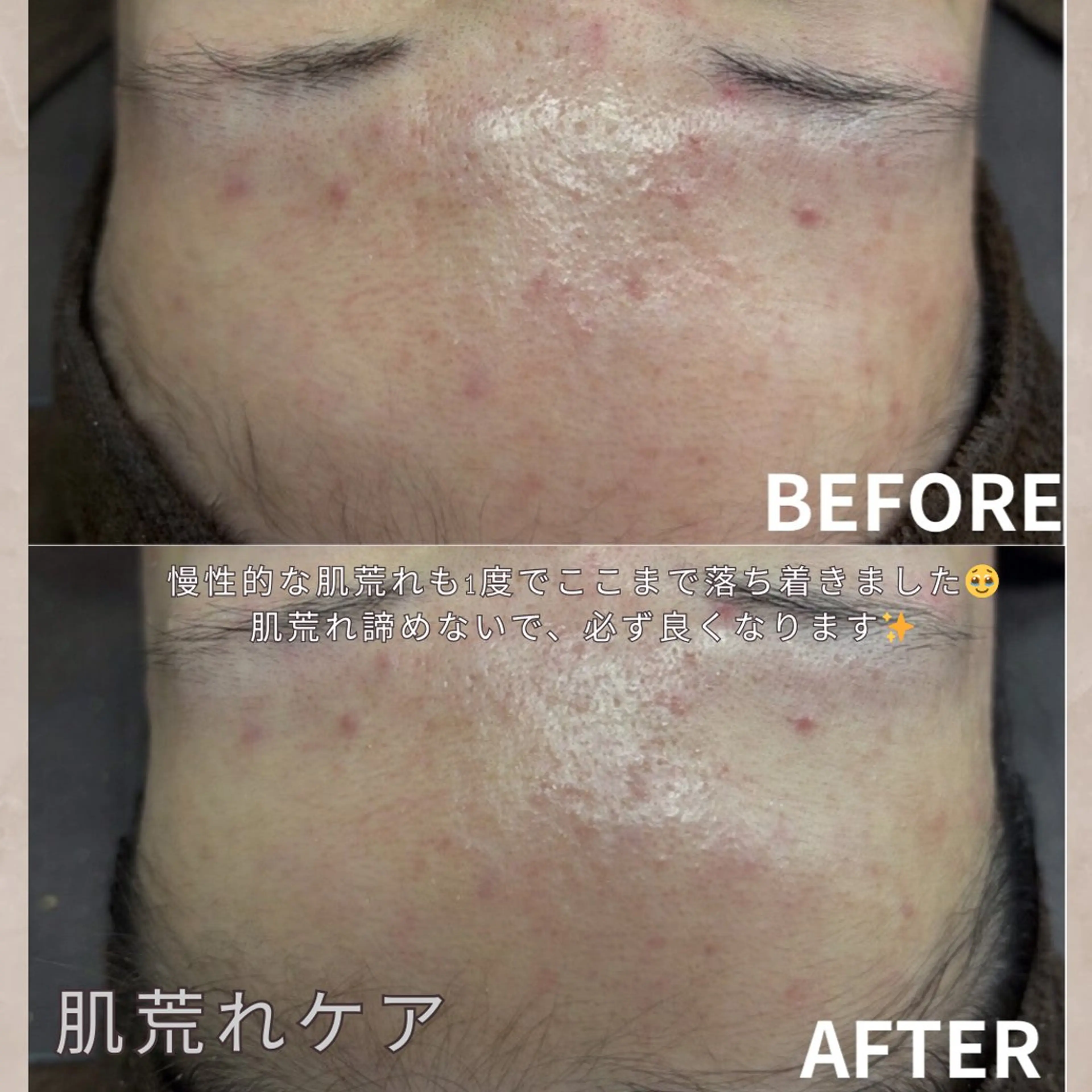 【ニキビ肌から艶肌に✨】お試しダウンタイム痛みなし✖️ニキビ跡や軽度のクレーターにも◎幹細胞ハーブピーリング🌿90分の写真