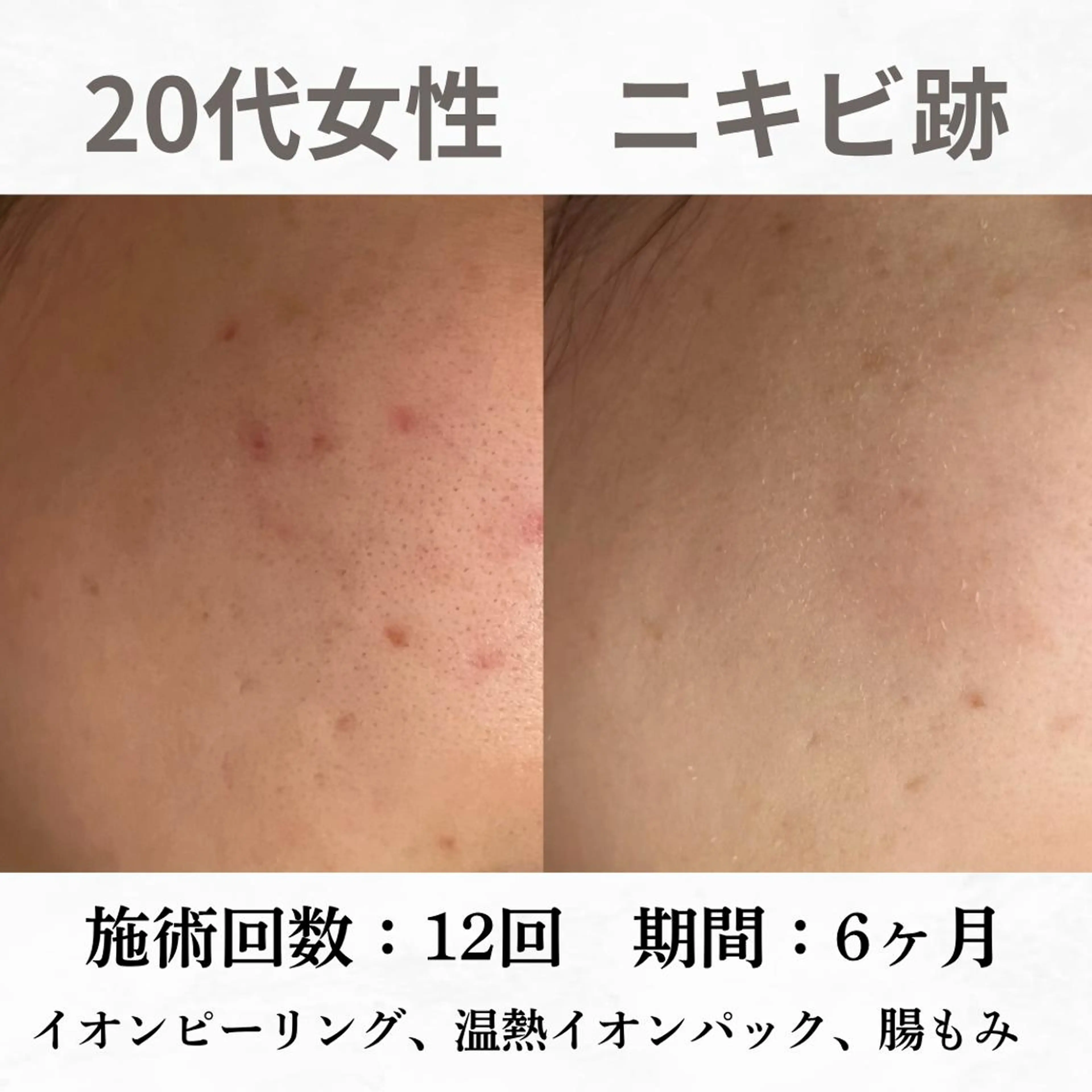 重度ニキビ専門🌷 ダウンタイムなしのエステ・リラクイメージ