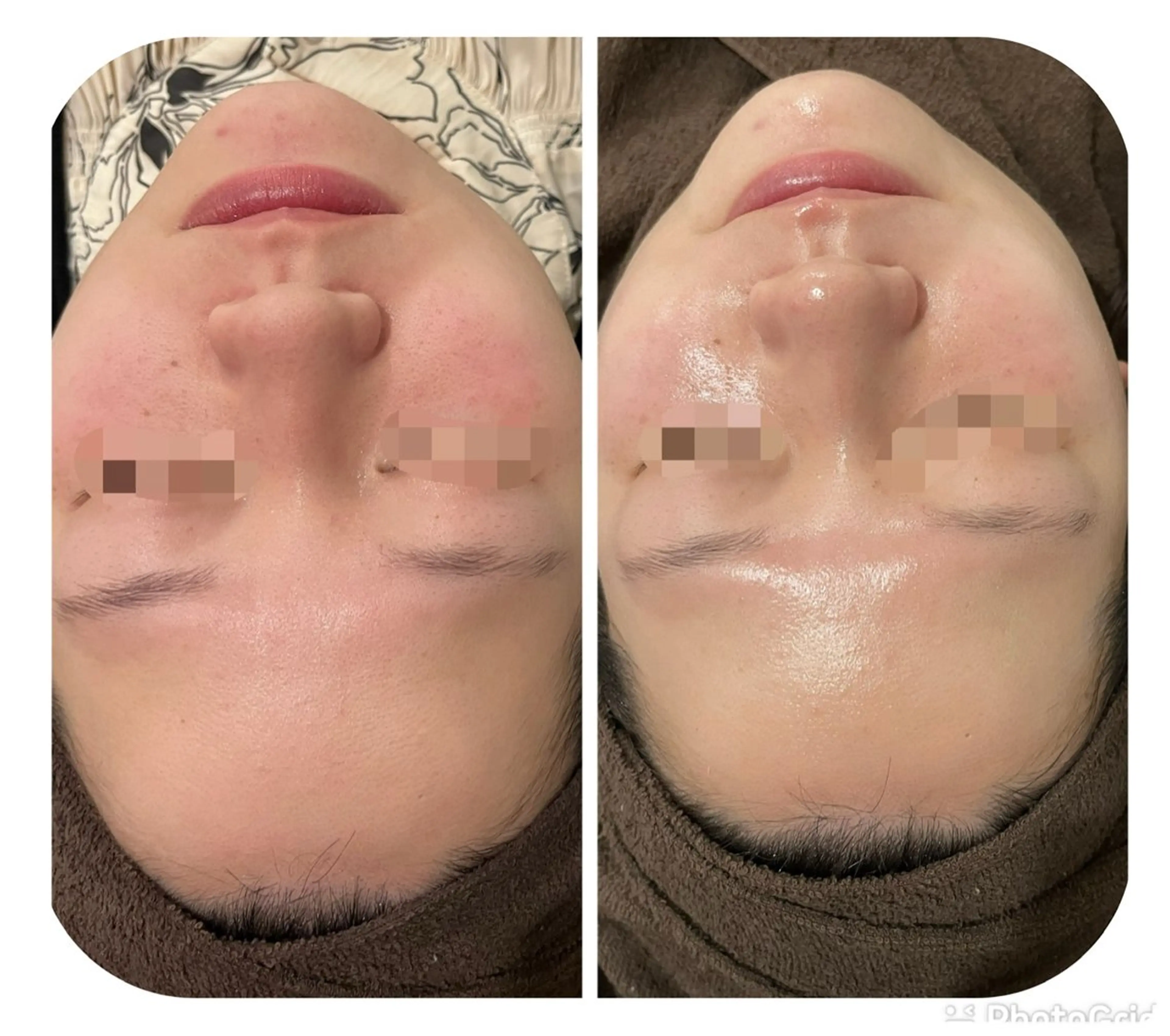 陶肌トリートメント＆お顔脱毛の写真