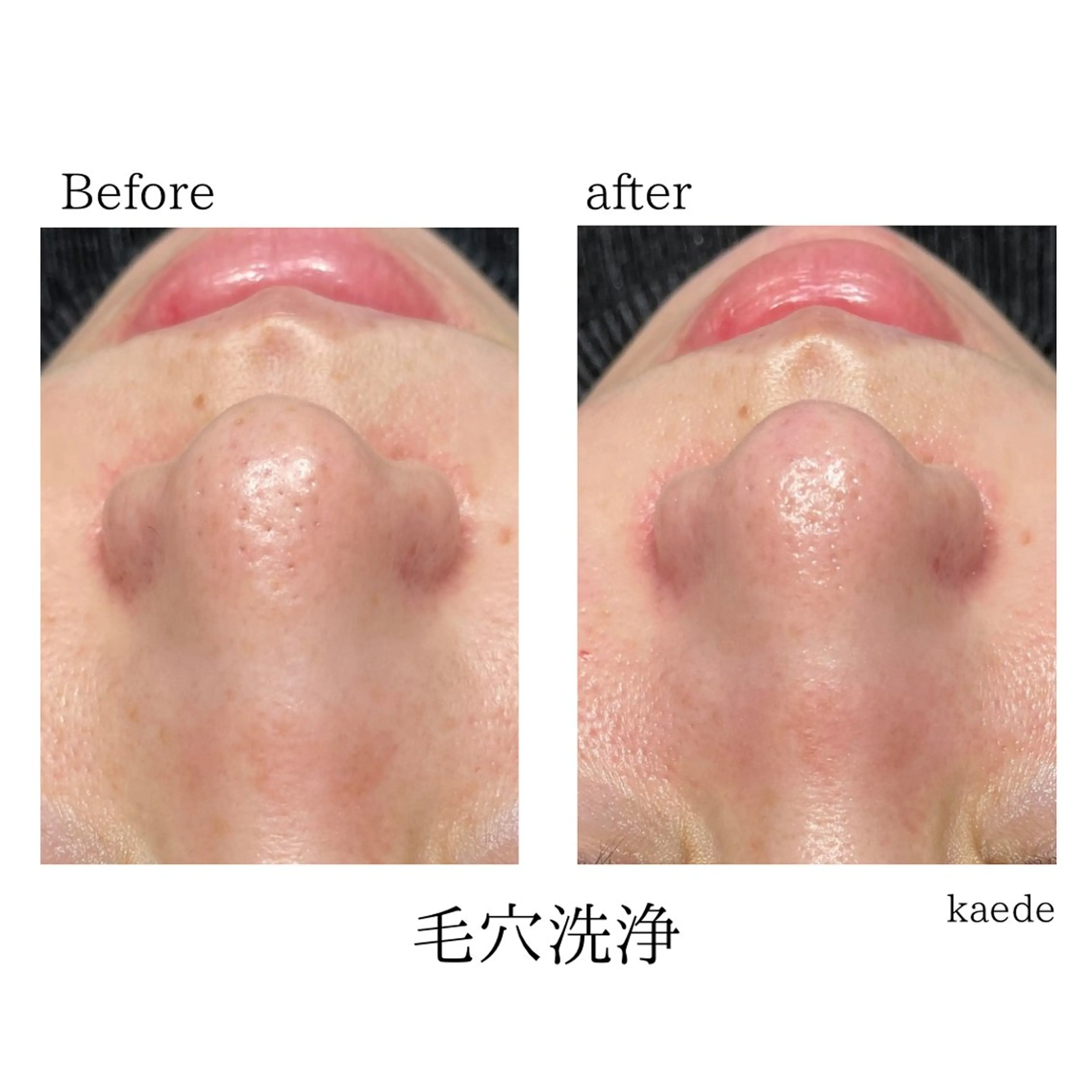 エステ 🎀kaede🎀 骨格似合わせ眉毛の眉毛・アイブロウイメージ