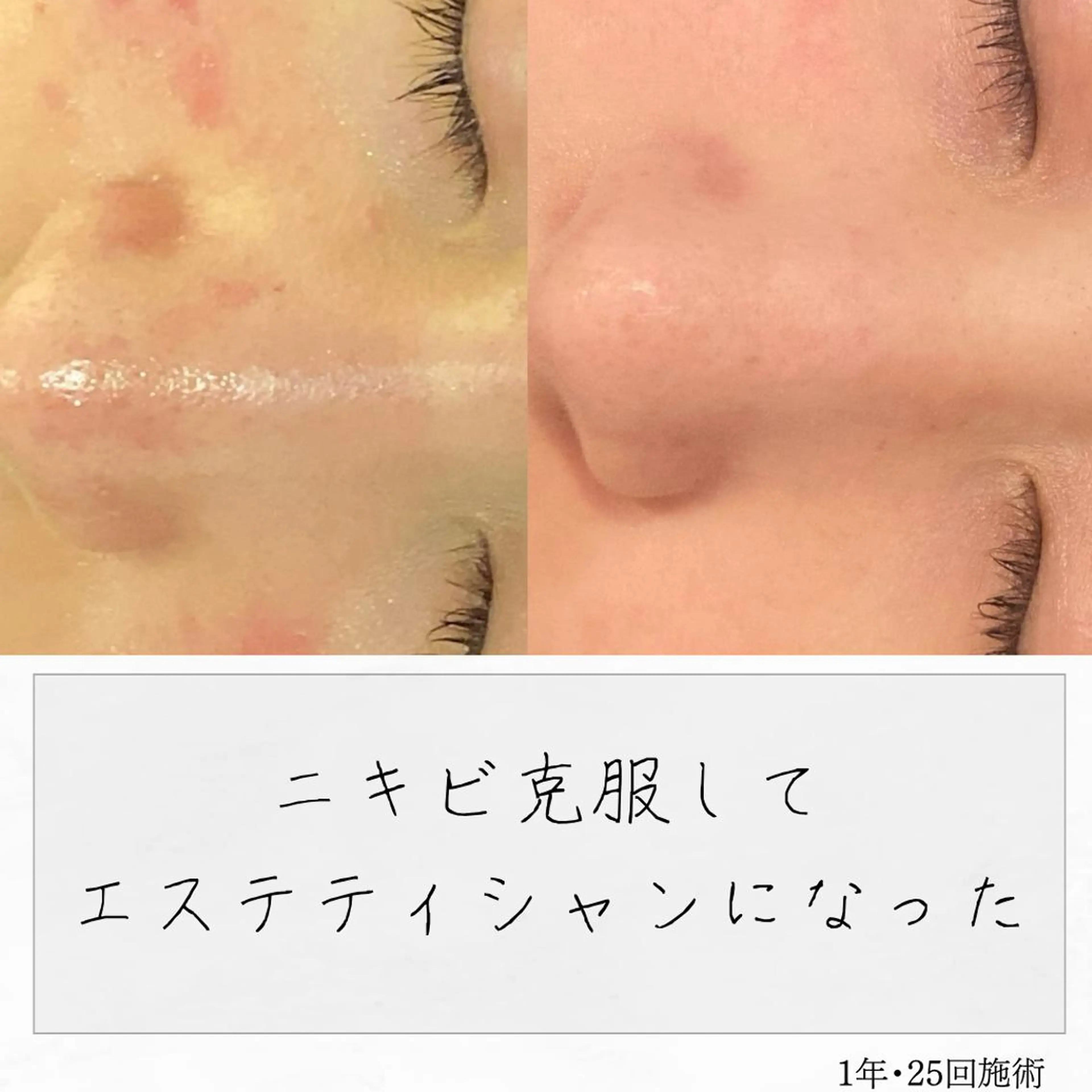 ニキビ経験者が施術 する専門サロン🌻のエステ・リラクイメージ