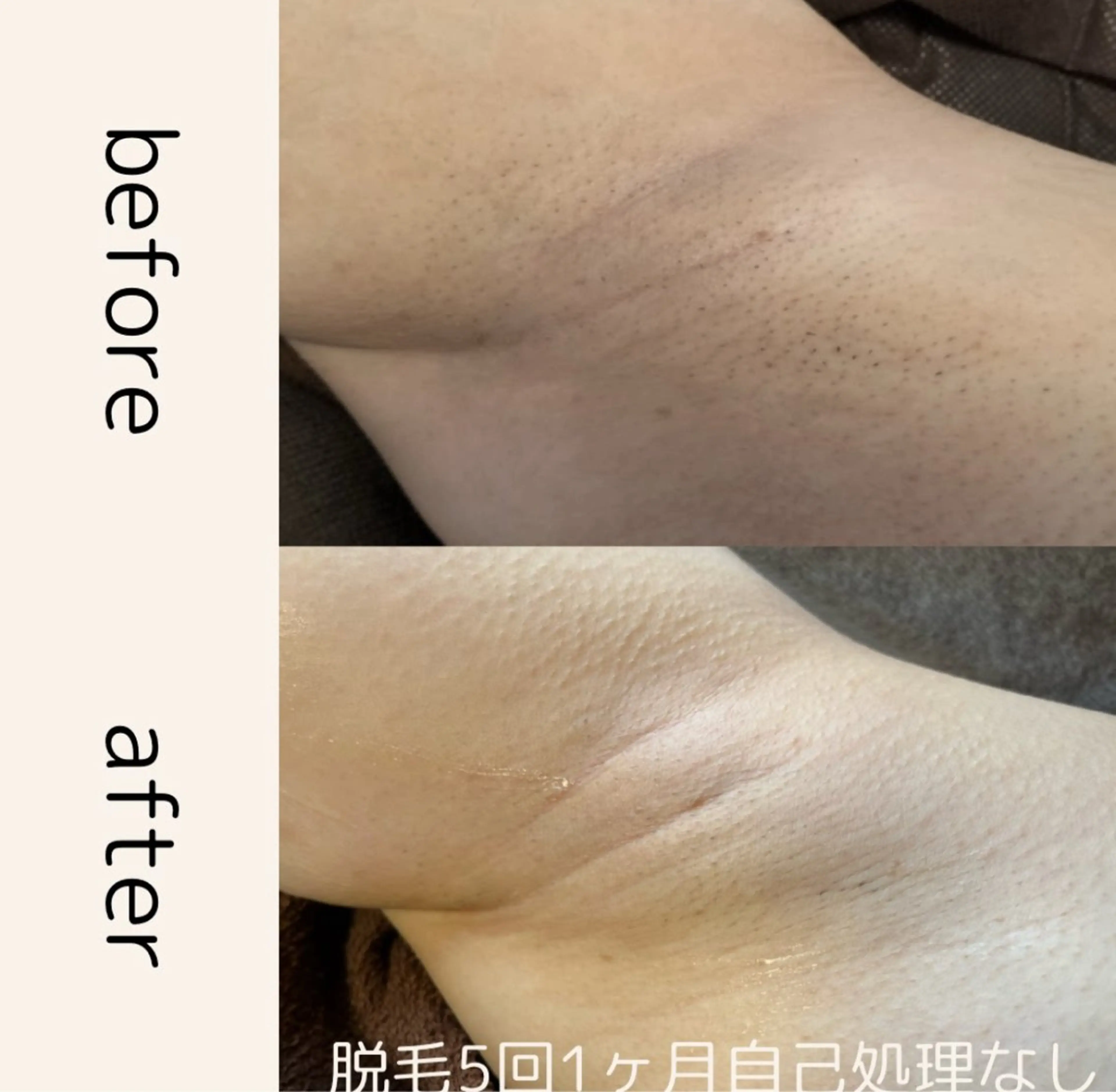 脱毛 Momo.所属・相模大野のサロン🌿 Momo.のエステ・リラクイメージ