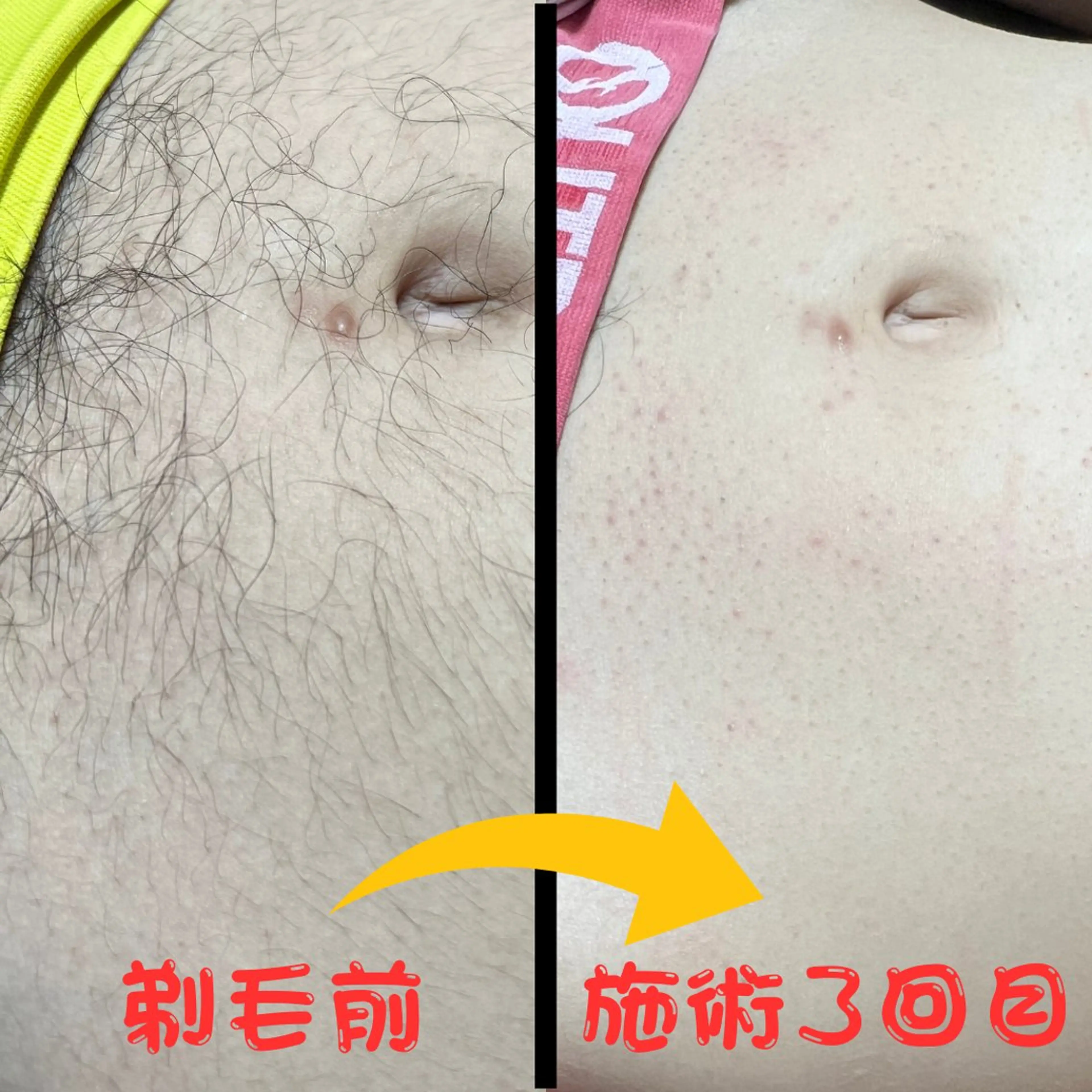 メンズ キッズ 脱毛 メンズ脱毛フェリッセ /男女🆗キッズ🆗のエステ・リラクイメージ