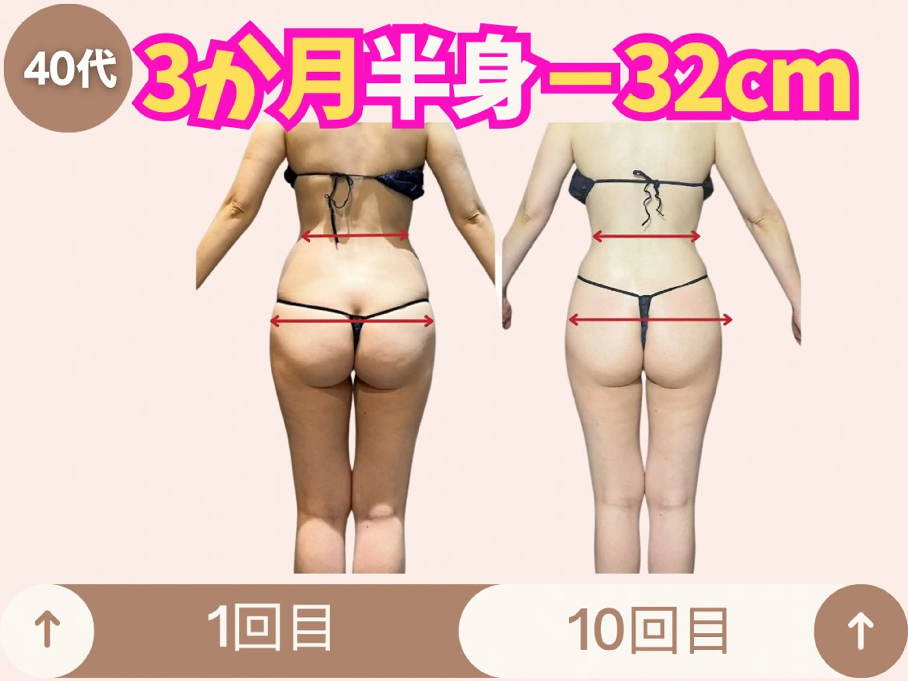 (初回限定) 部分集中引き締め痩身(太もも、ヒップ)の写真