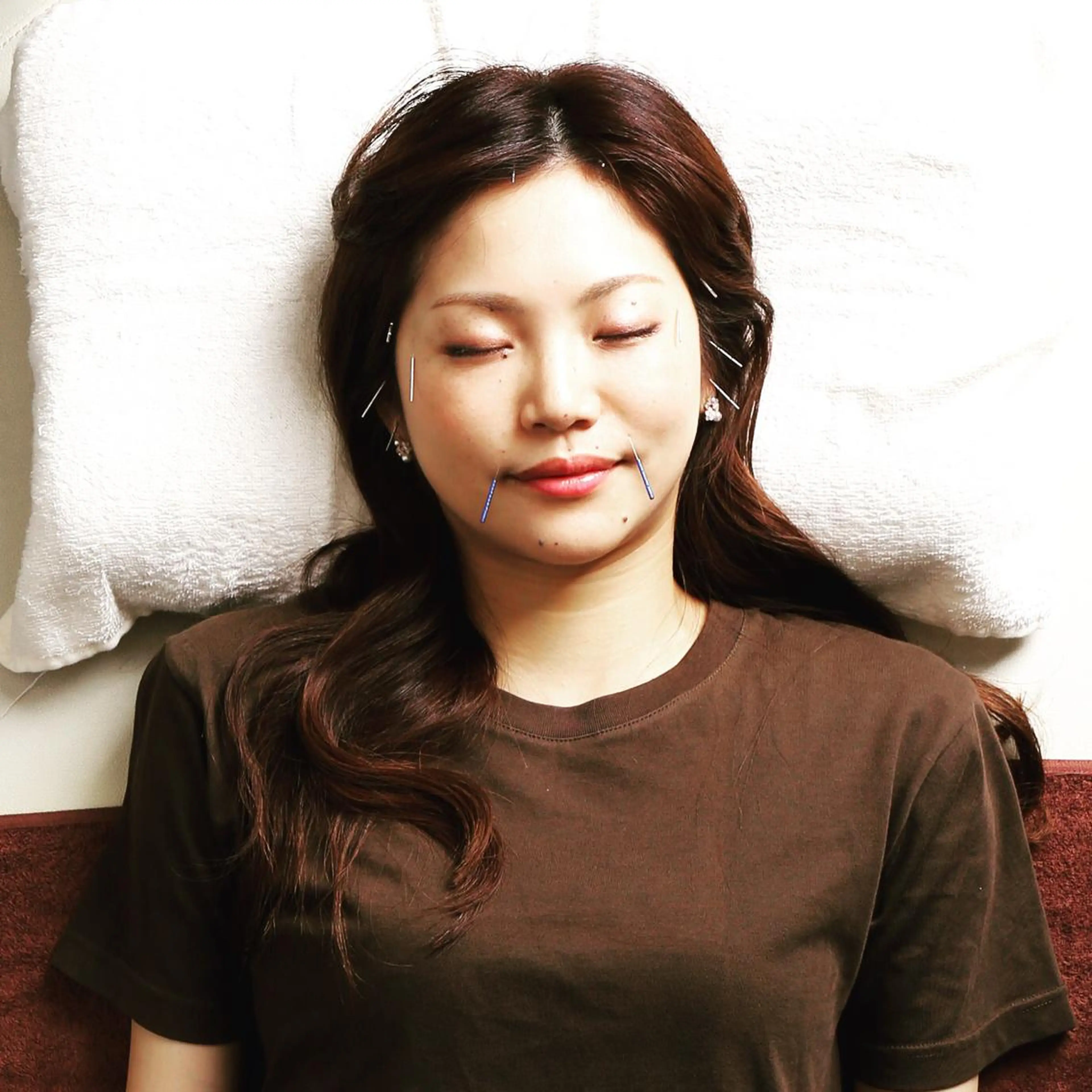 【平日期間限定特別スーパー価格☆新規限定☆】美容針（首・方のボディケア込み）20本コース　メンズokの写真