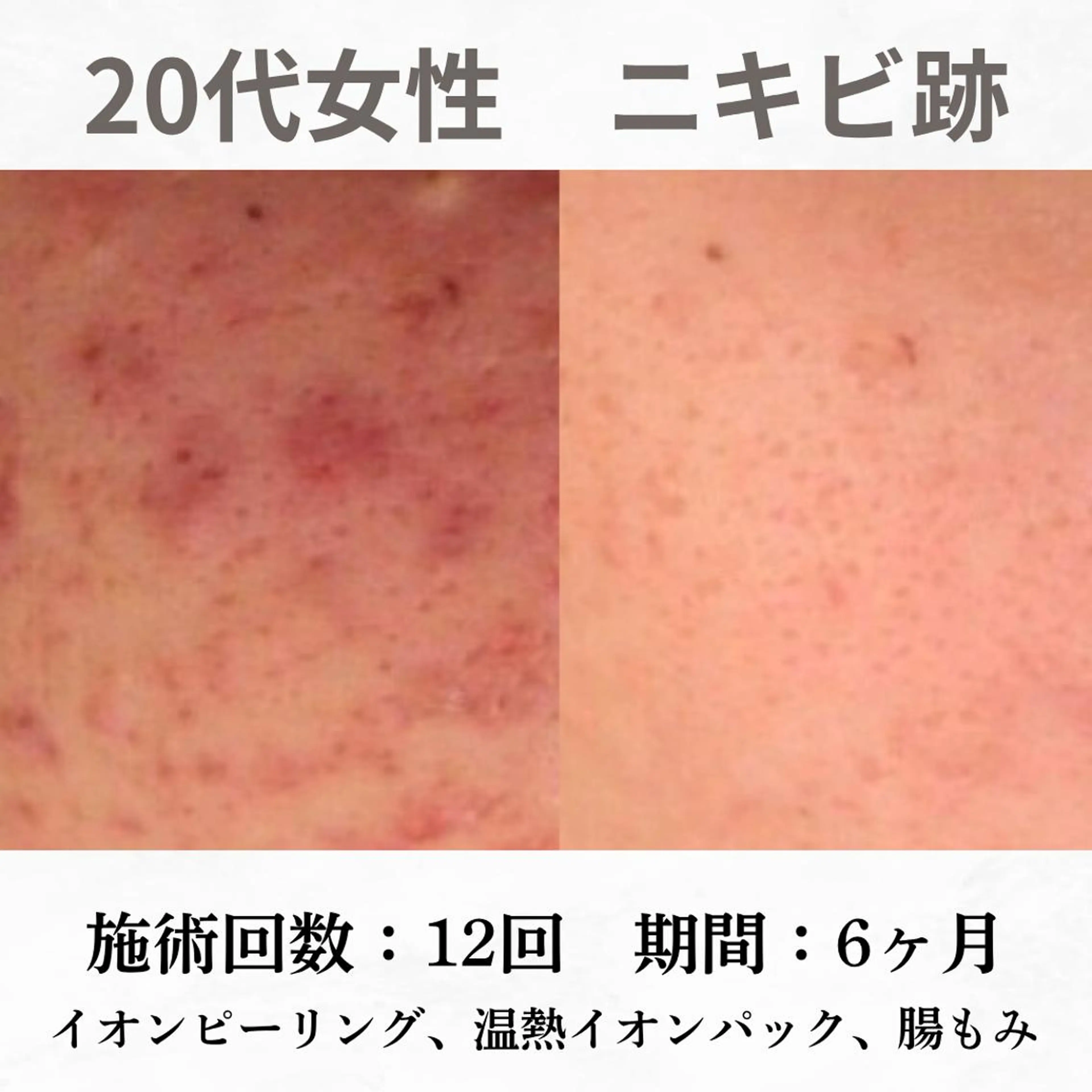 重度ニキビ専門🌷 ダウンタイムなしのエステ・リラクイメージ