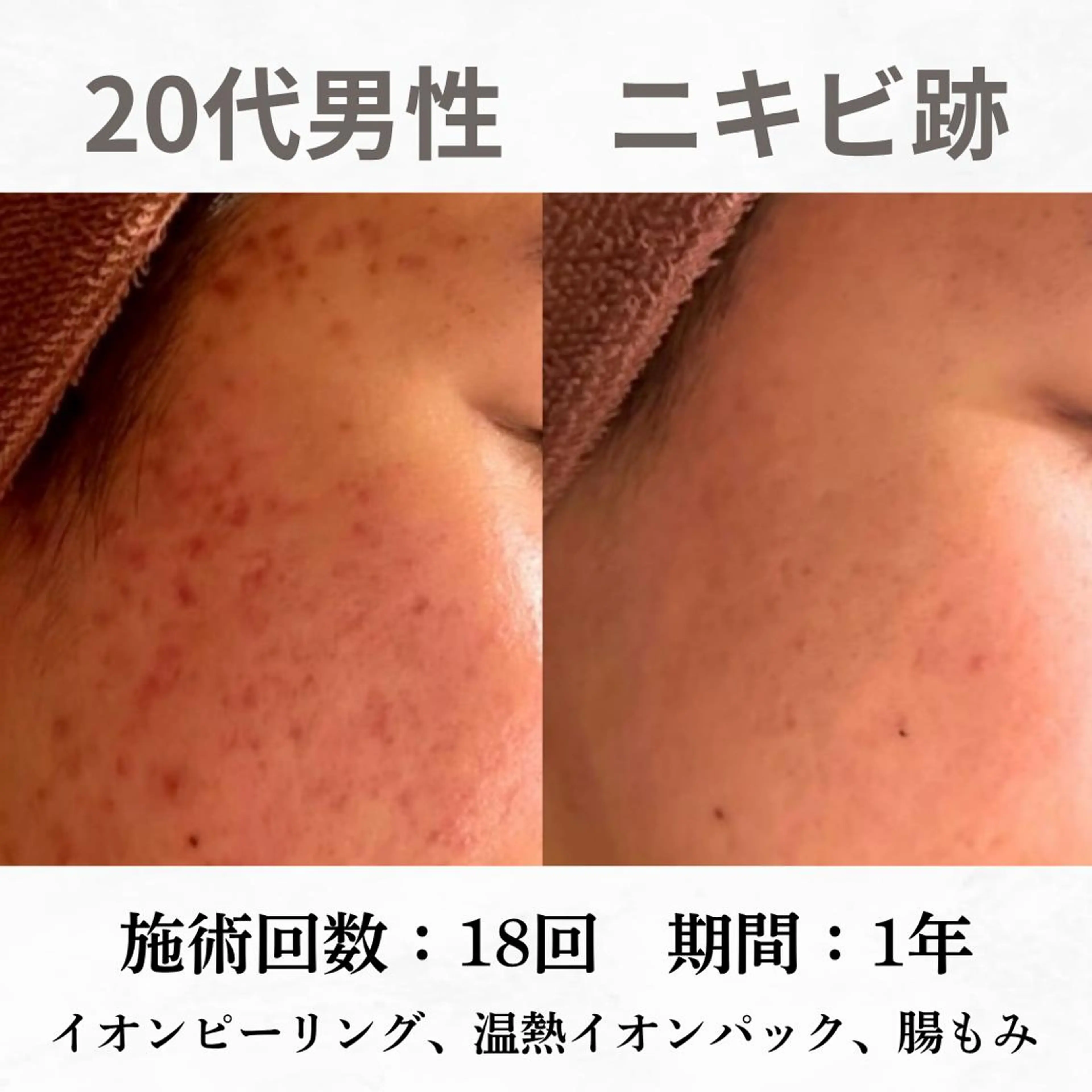 重度ニキビ専門🌷 ダウンタイムなしのエステ・リラクイメージ