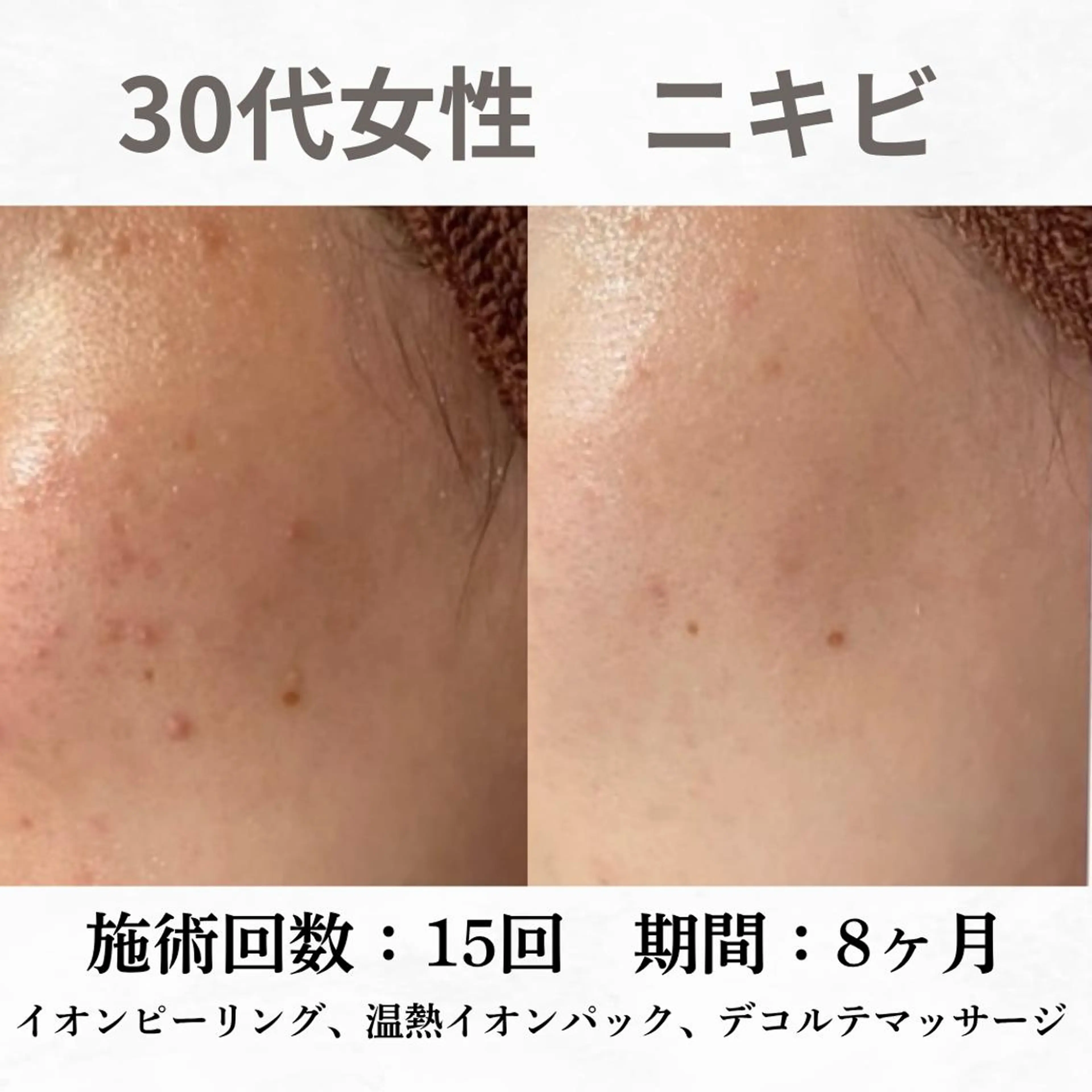 重度ニキビ専門🌷 ダウンタイムなしのエステ・リラクイメージ