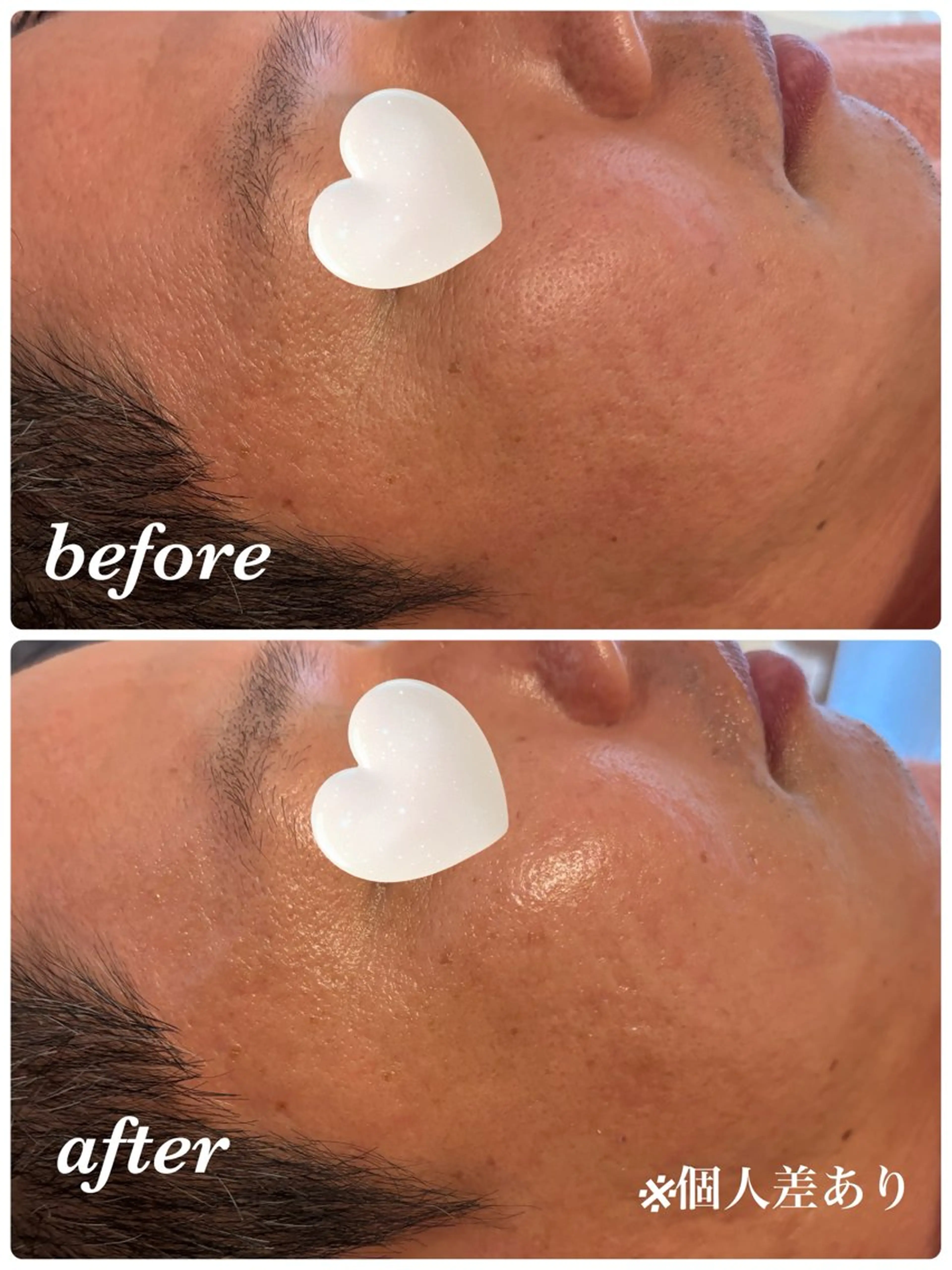 《メンズ限定》毛穴＋ニキビ集中ケアで清潔感UP！¥9,800の写真