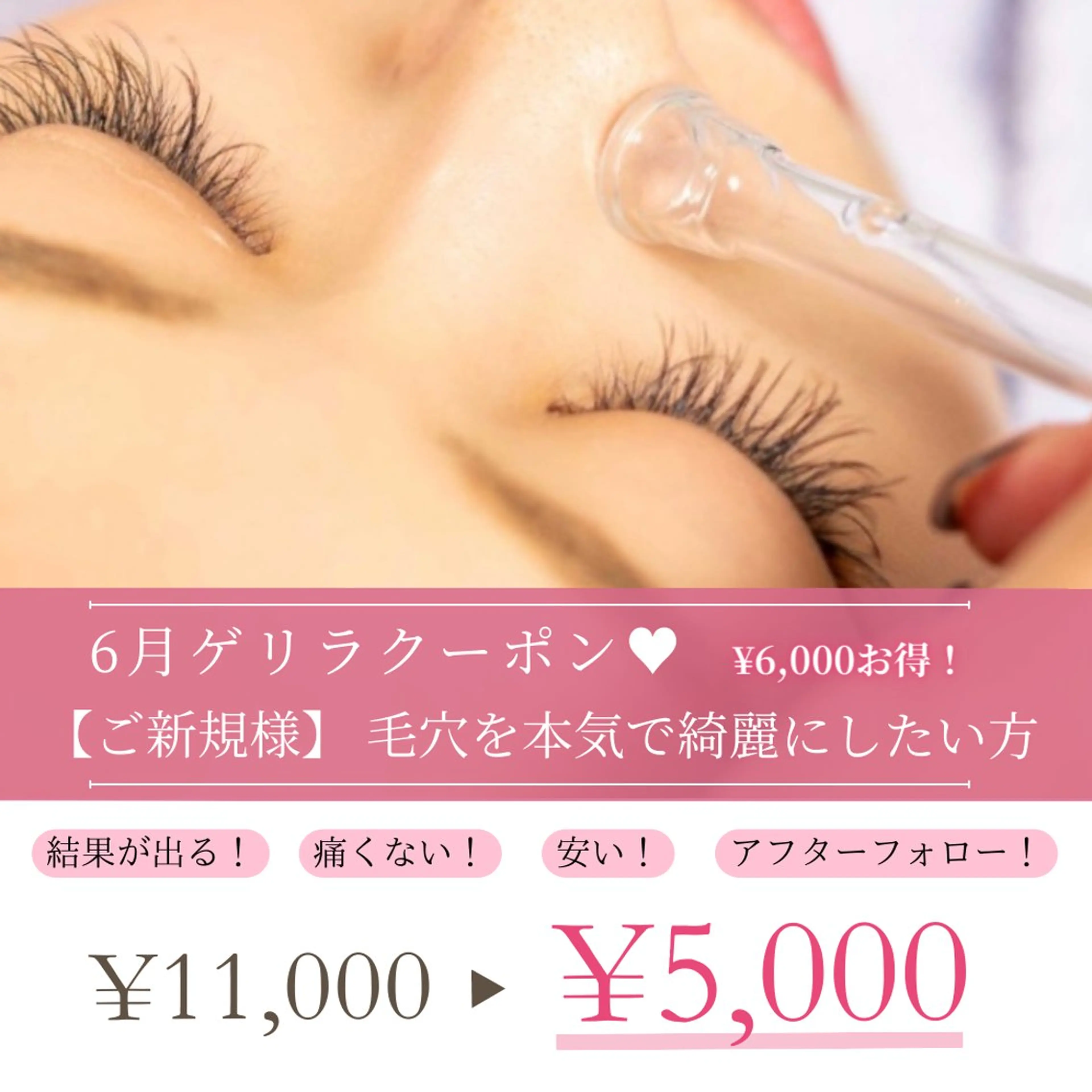 【期間限定★】本気の毛穴ケアはこちら♪¥11,000→¥5,000の写真